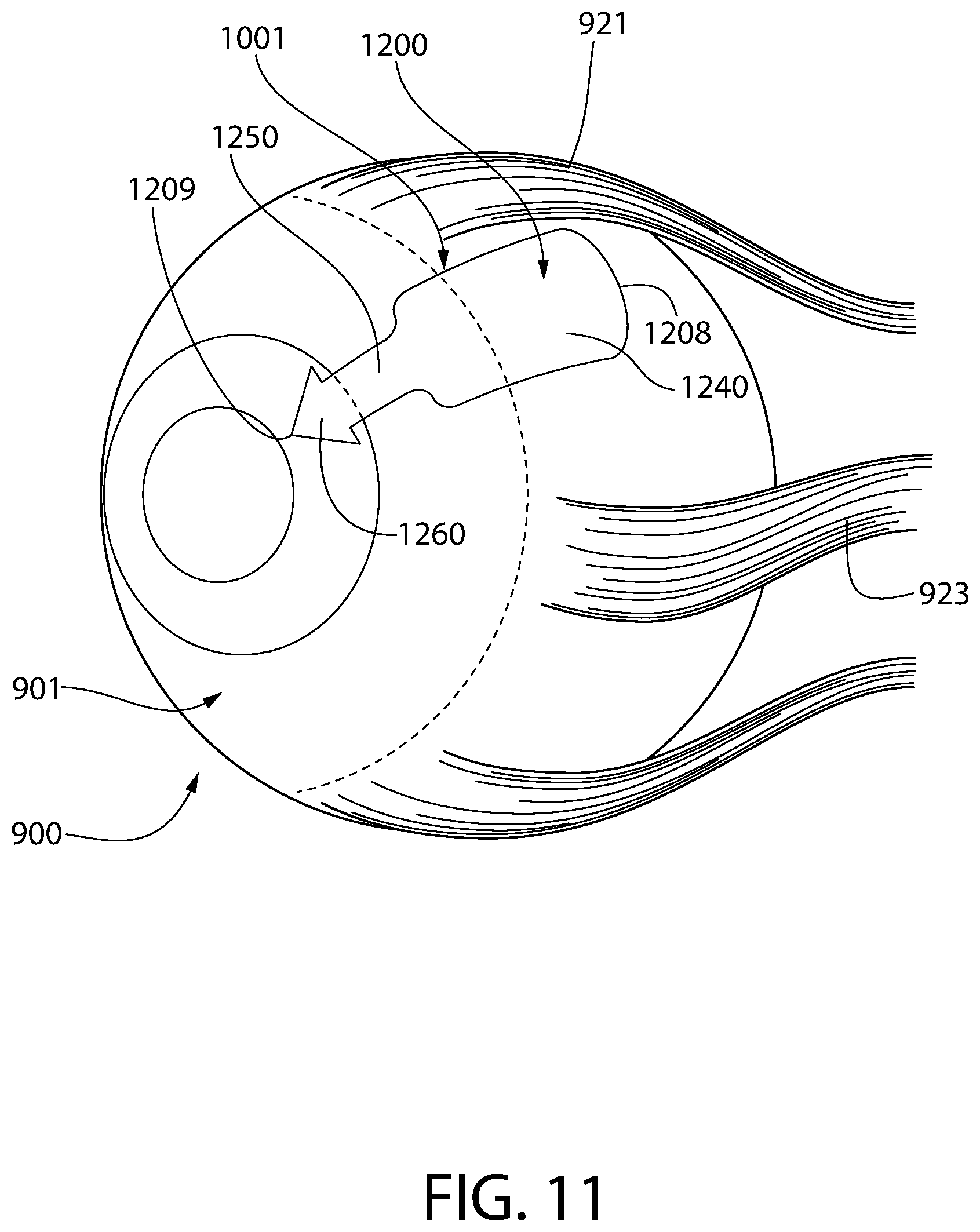 Patent US12303429 Figure 11 – Method and device for treating eye disease