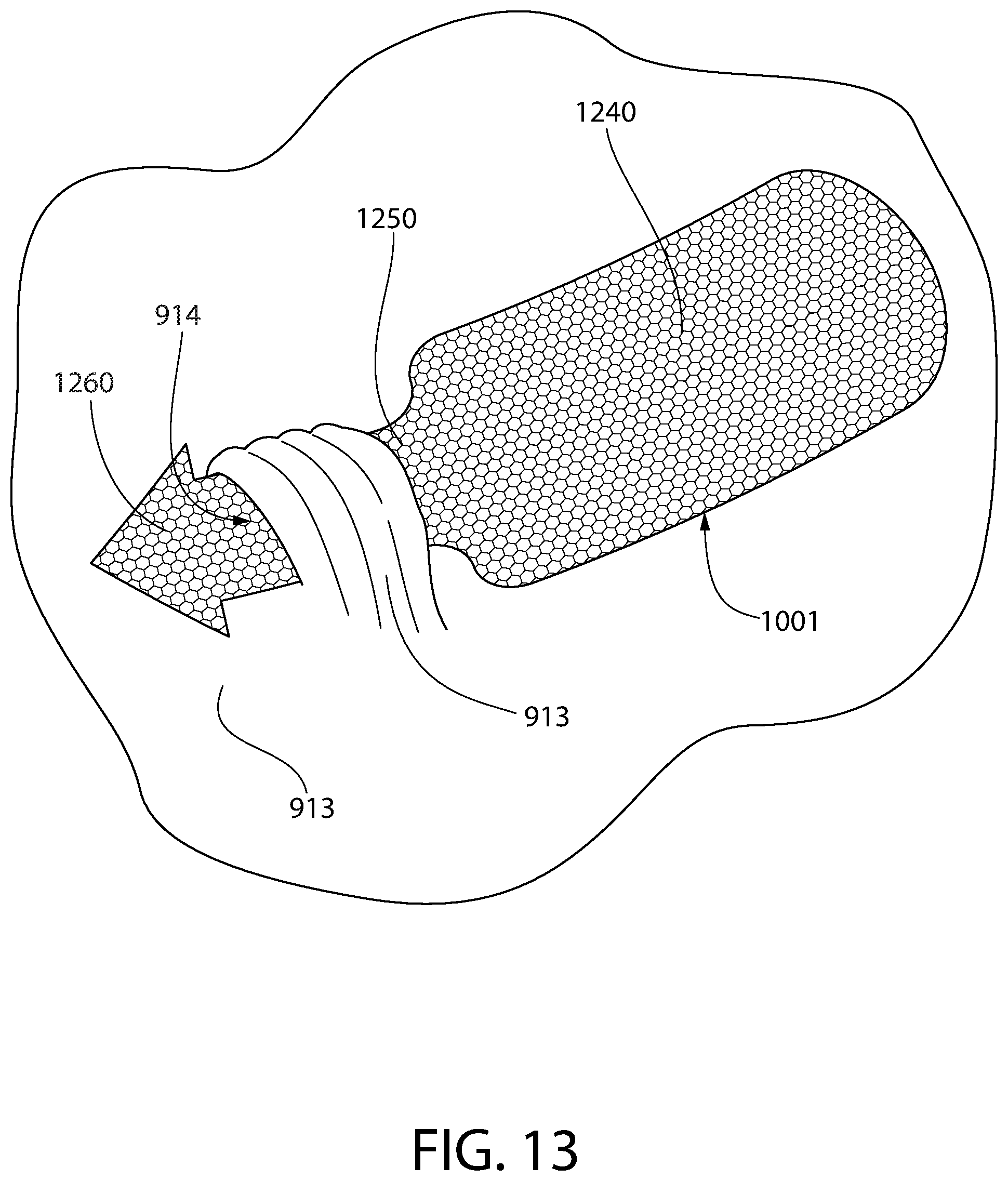 Patent US12303429 Figure 13 – Method and device for treating eye disease