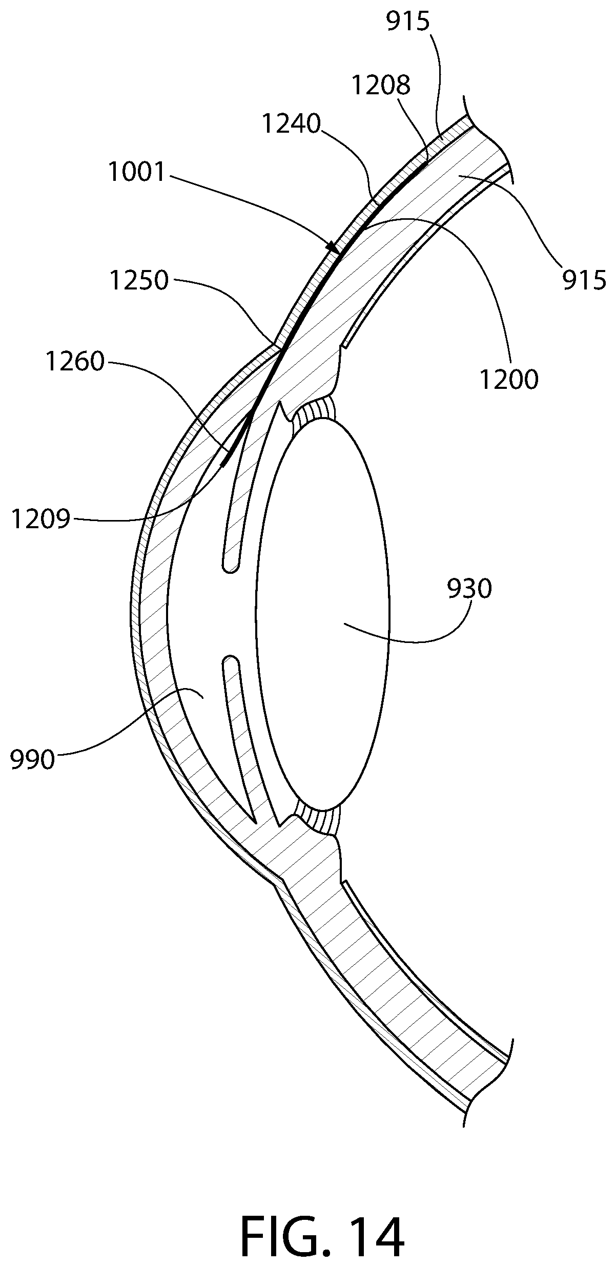 Patent US12303429 Figure 14 – Method and device for treating eye disease