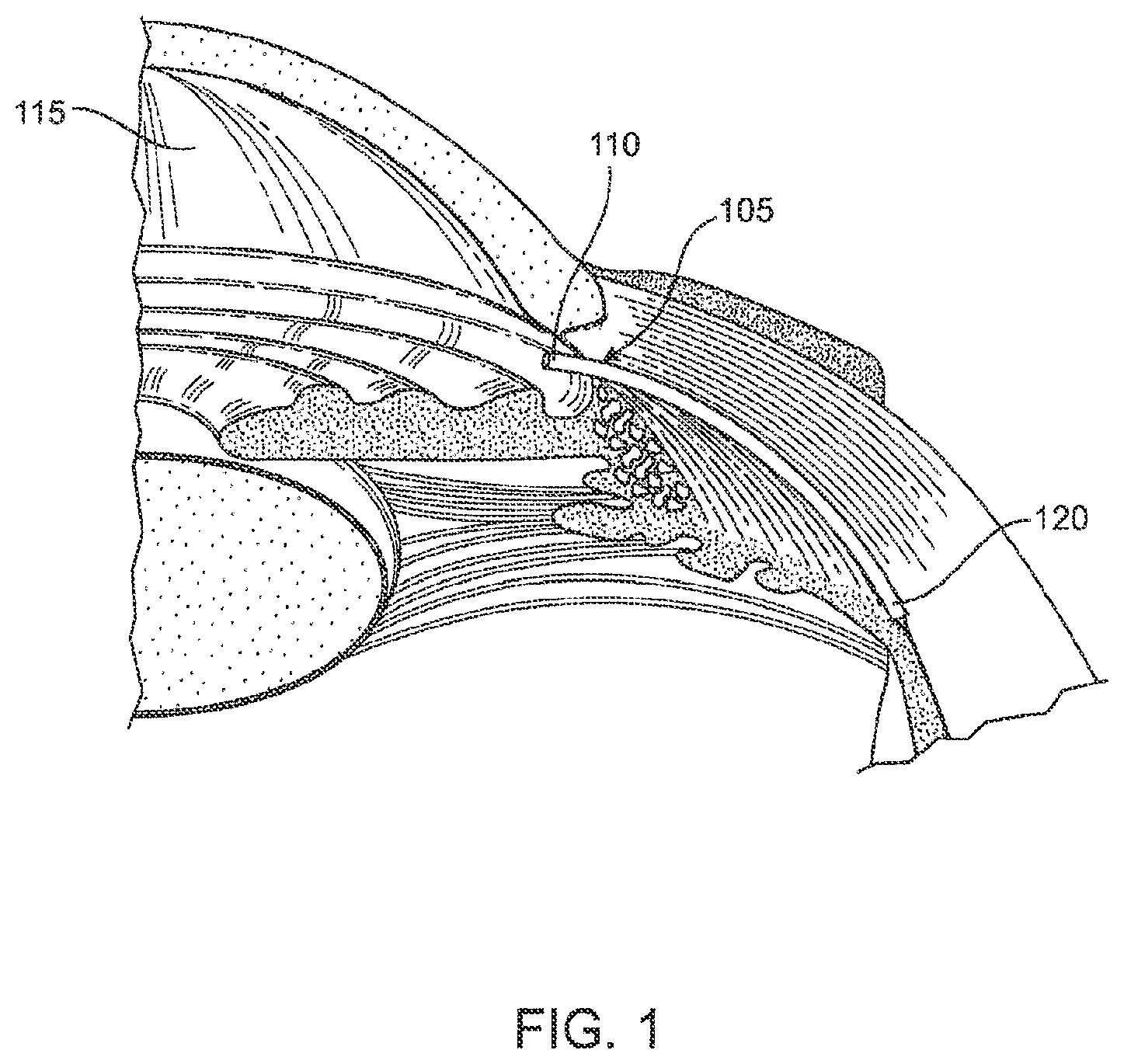 Patent US12303430 — Glaucoma treatment device — Figure 1