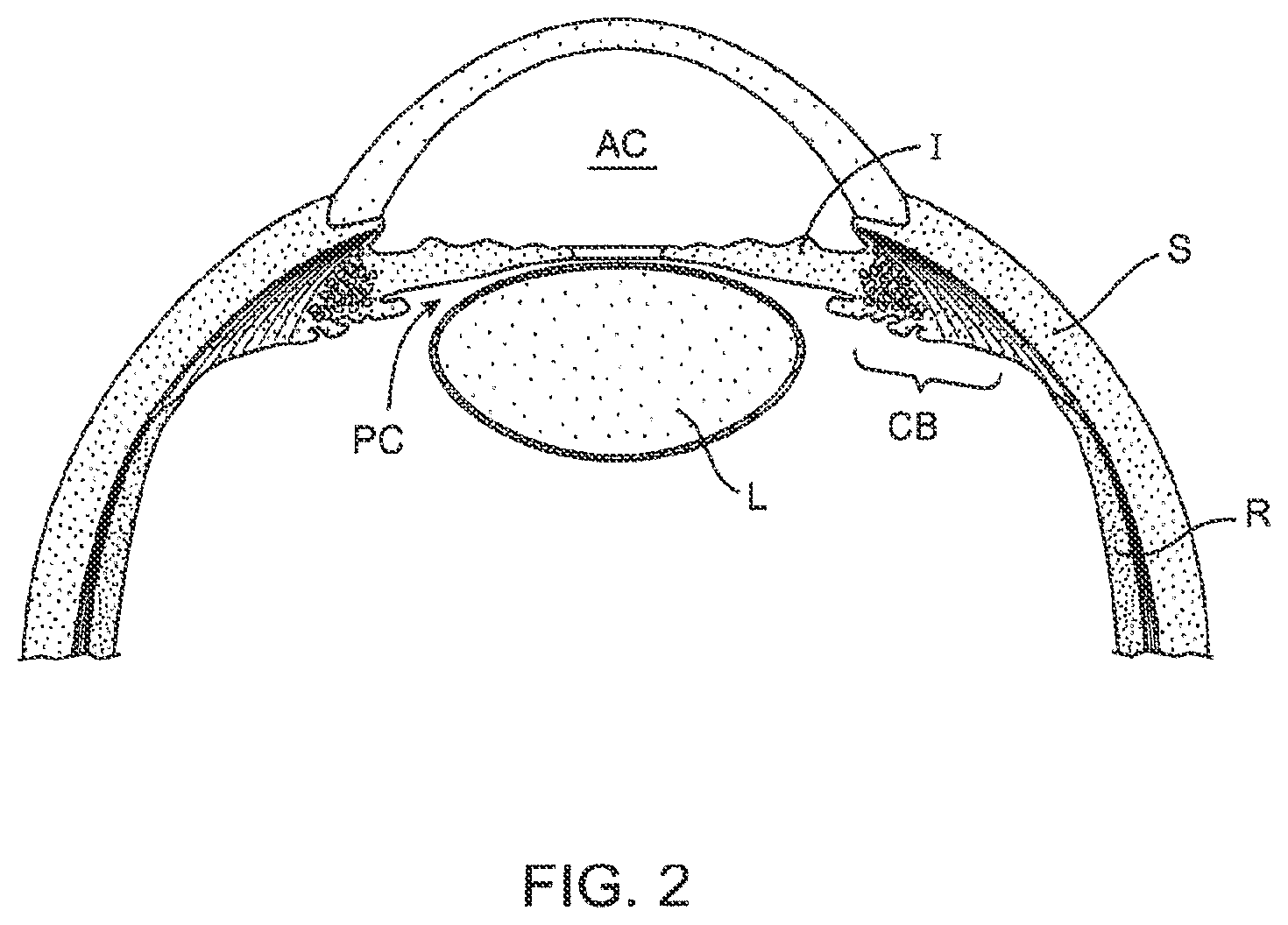 Patent US12303430 Figure 2 – Glaucoma treatment device