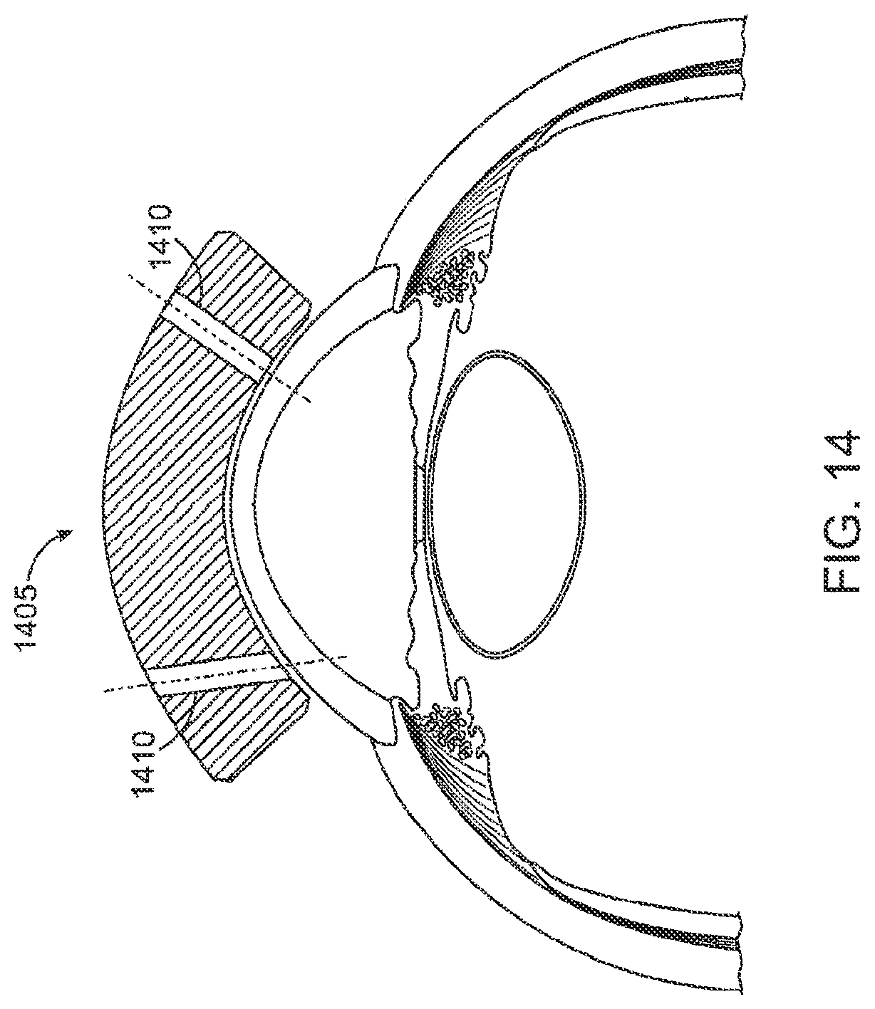 Patent US12303430 Figure 13 – Glaucoma treatment device
