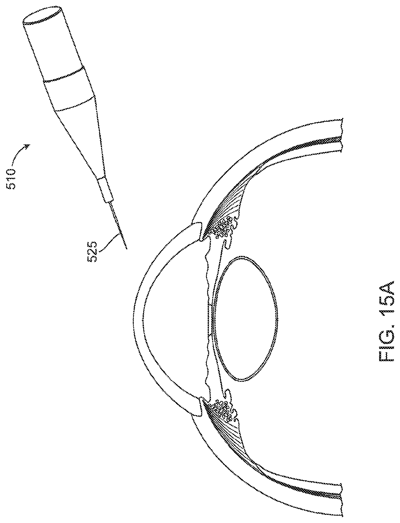 Patent US12303430 Figure 14 – Glaucoma treatment device