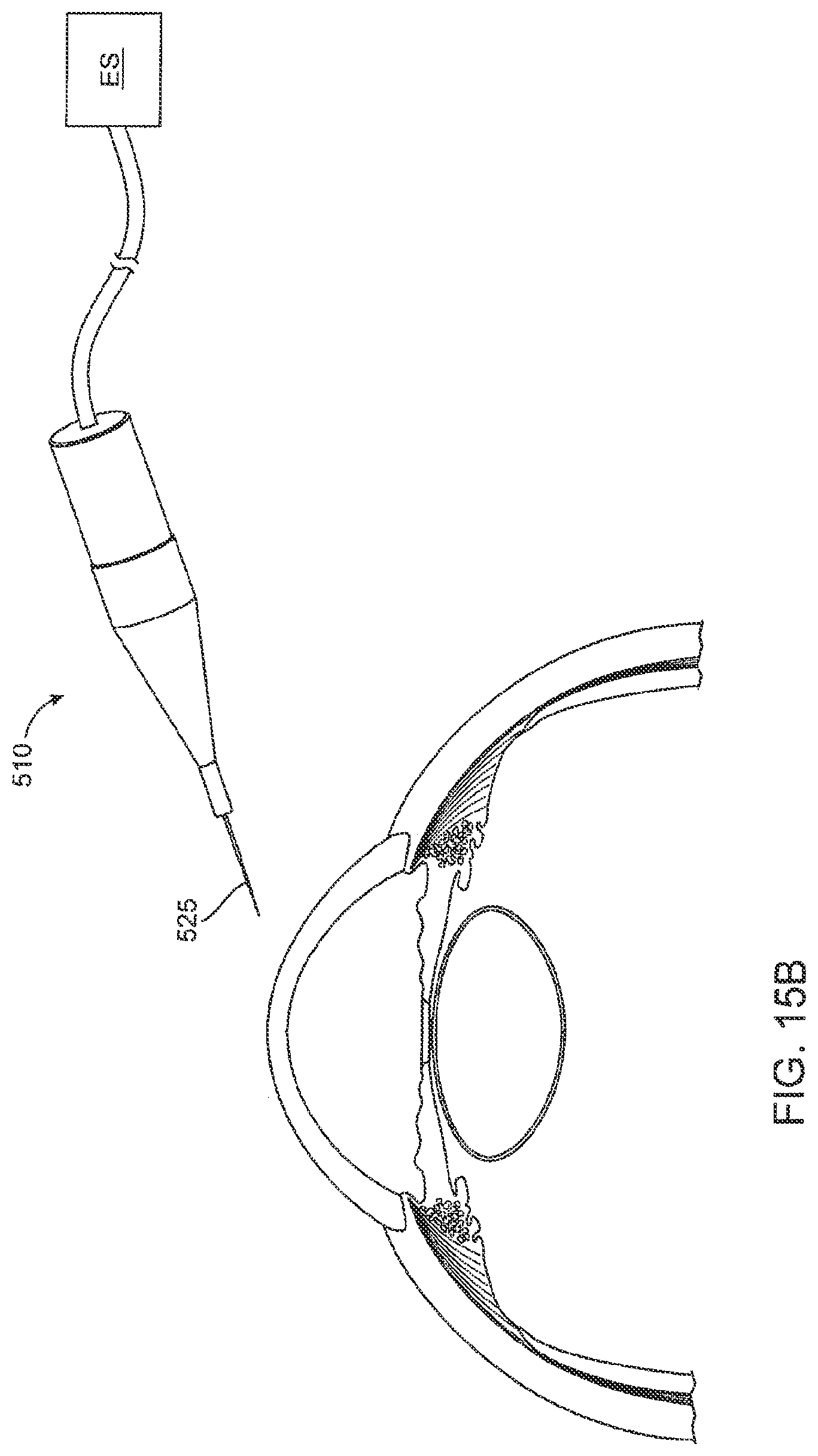 Patent US12303430 Figure 15 – Glaucoma treatment device