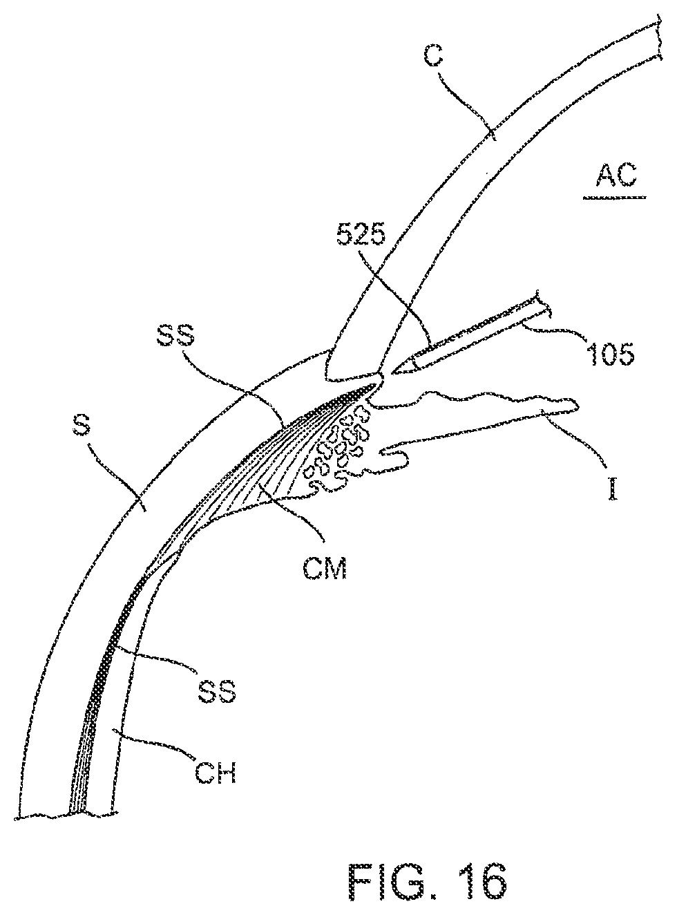 Patent US12303430 Figure 16 – Glaucoma treatment device
