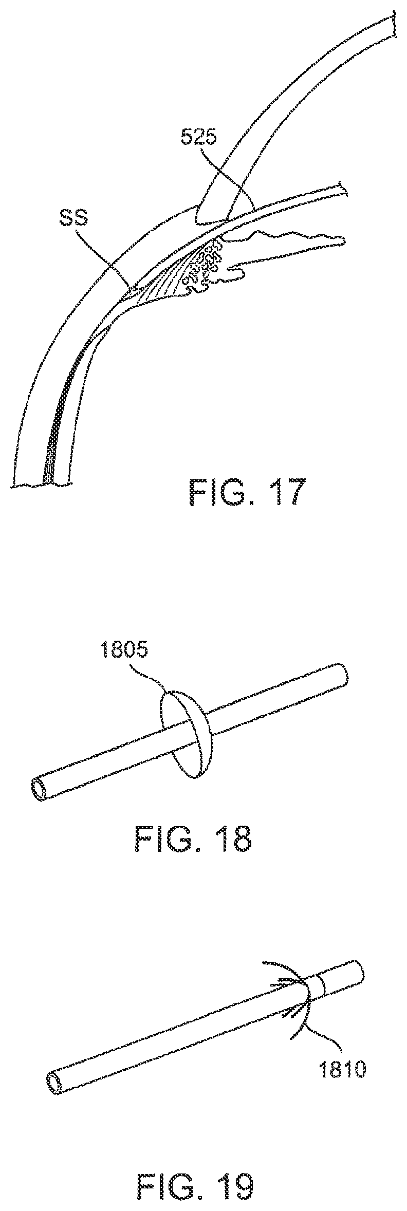 Patent US12303430 Figure 17 – Glaucoma treatment device