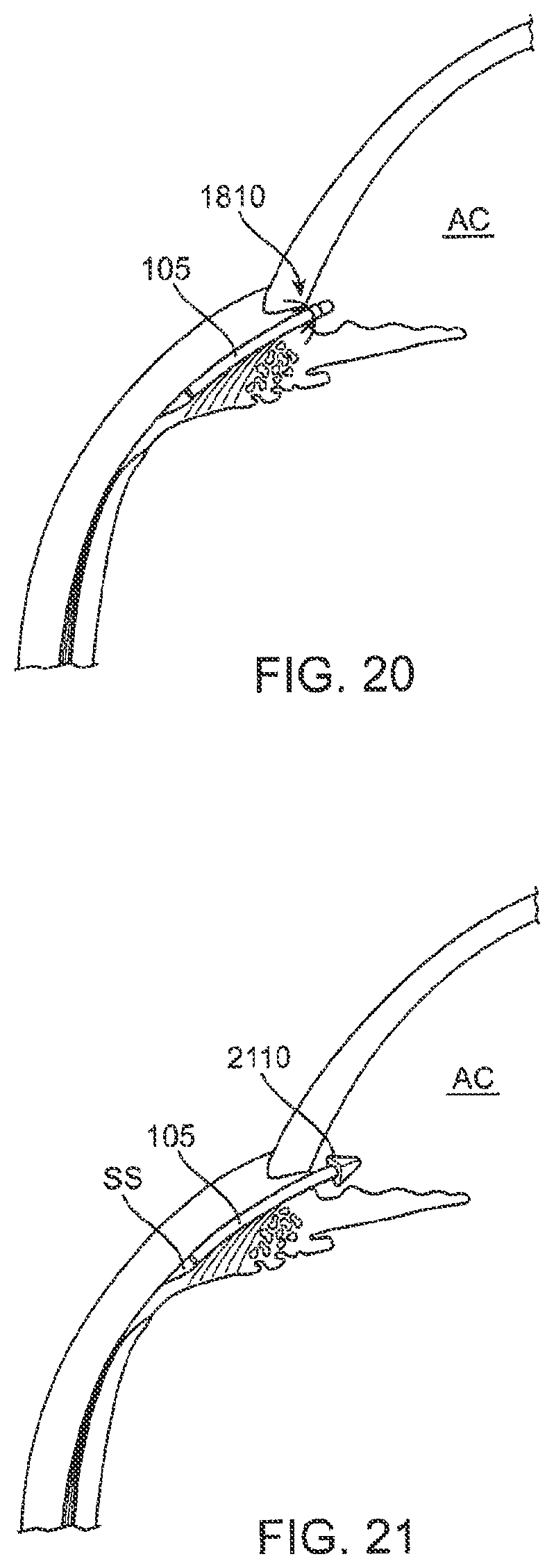 Patent US12303430 Figure 18 – Glaucoma treatment device