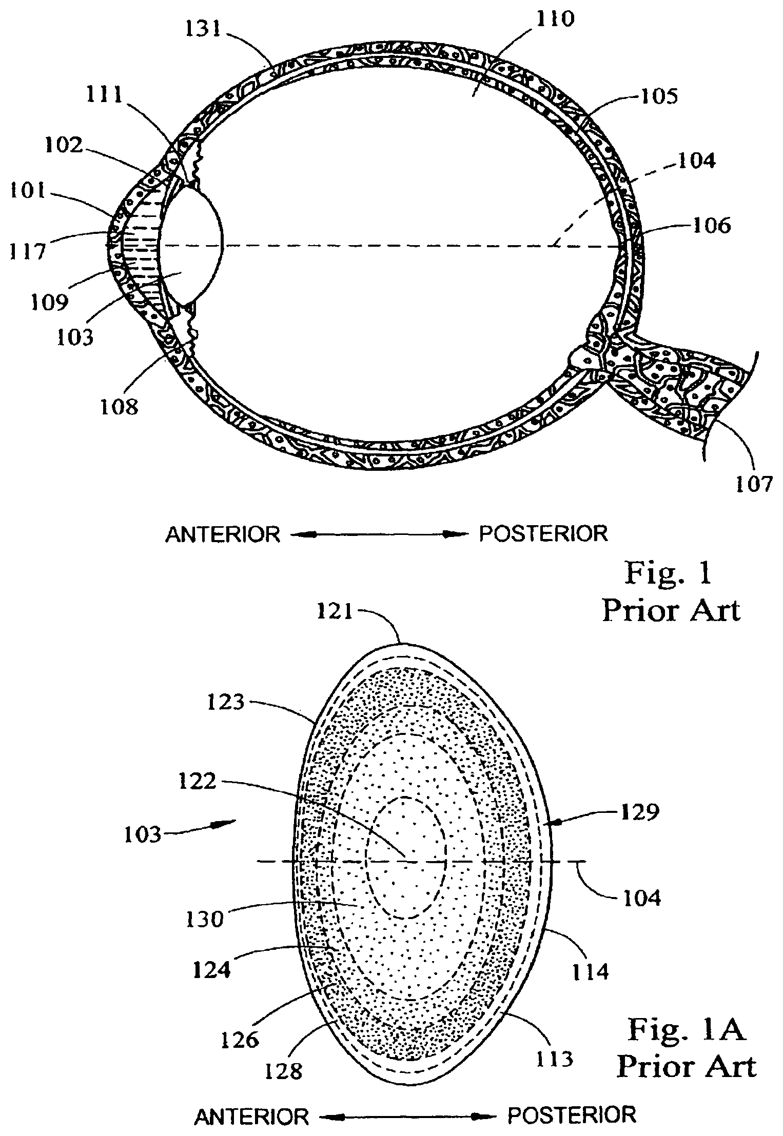 Patent US12303431 Figure 1 – System and apparatus for treating the lens of an eye