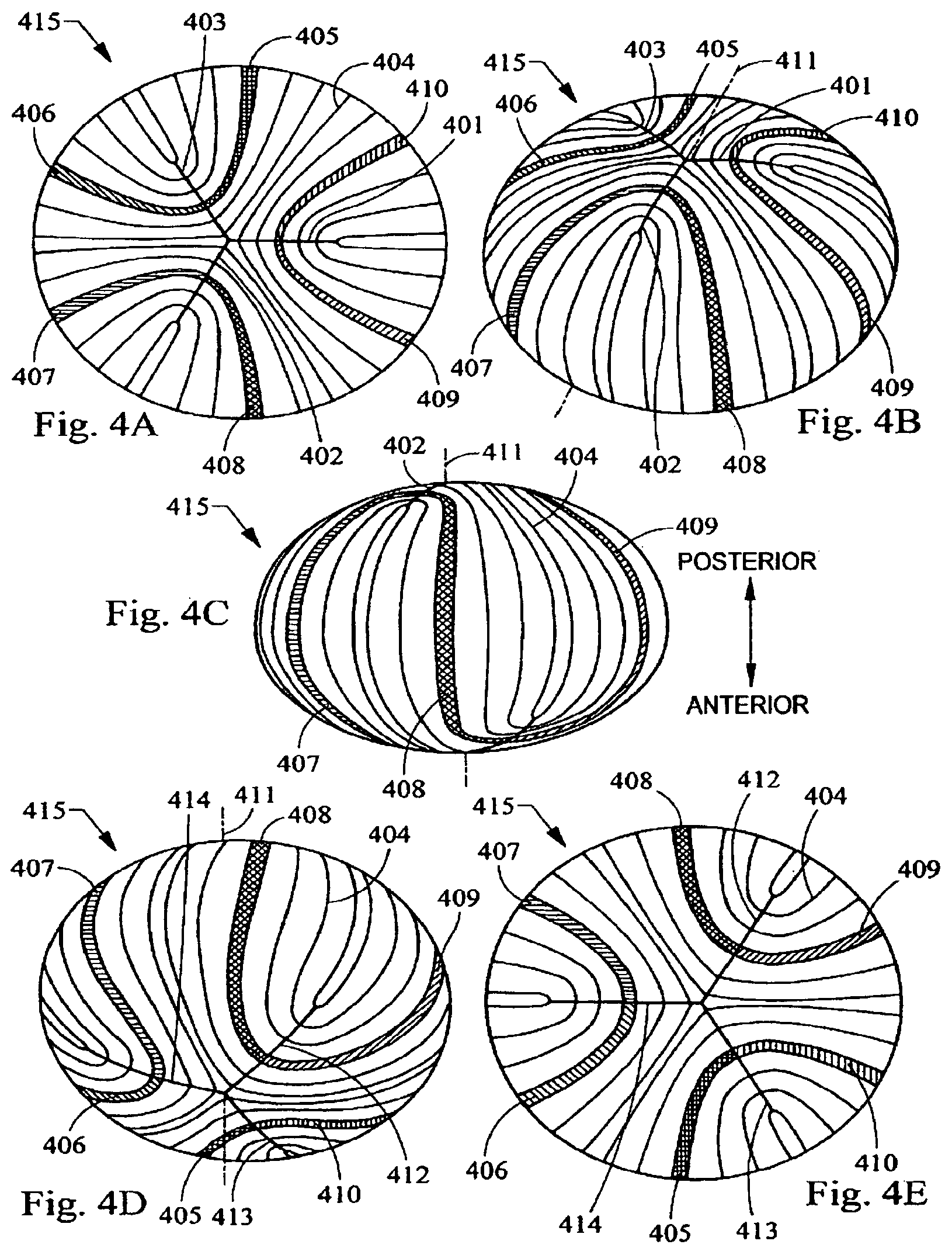 Patent US12303431 Figure 9 – System and apparatus for treating the lens of an eye