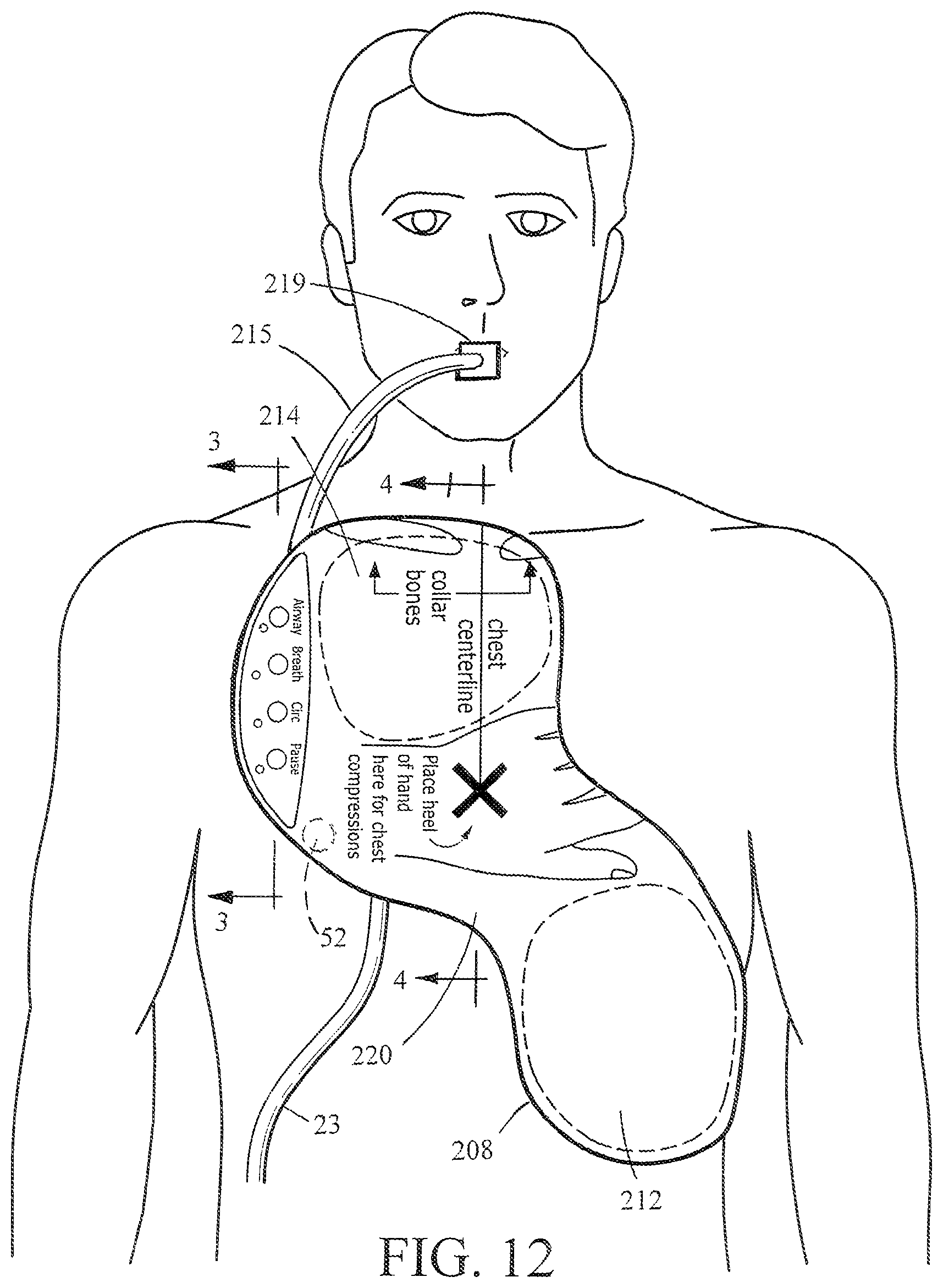 Patent US12303456 Figure 18 – Automated resuscitation device with ventilation sensing and prompting