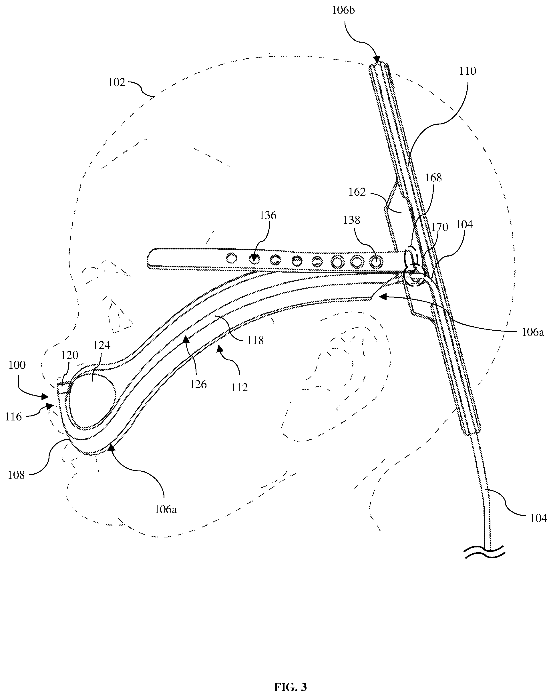 Patent US12303465 Figure 3 – Apparatus, methods, and systems for positioning and retaining a nasally introduced medical tube to a patient
