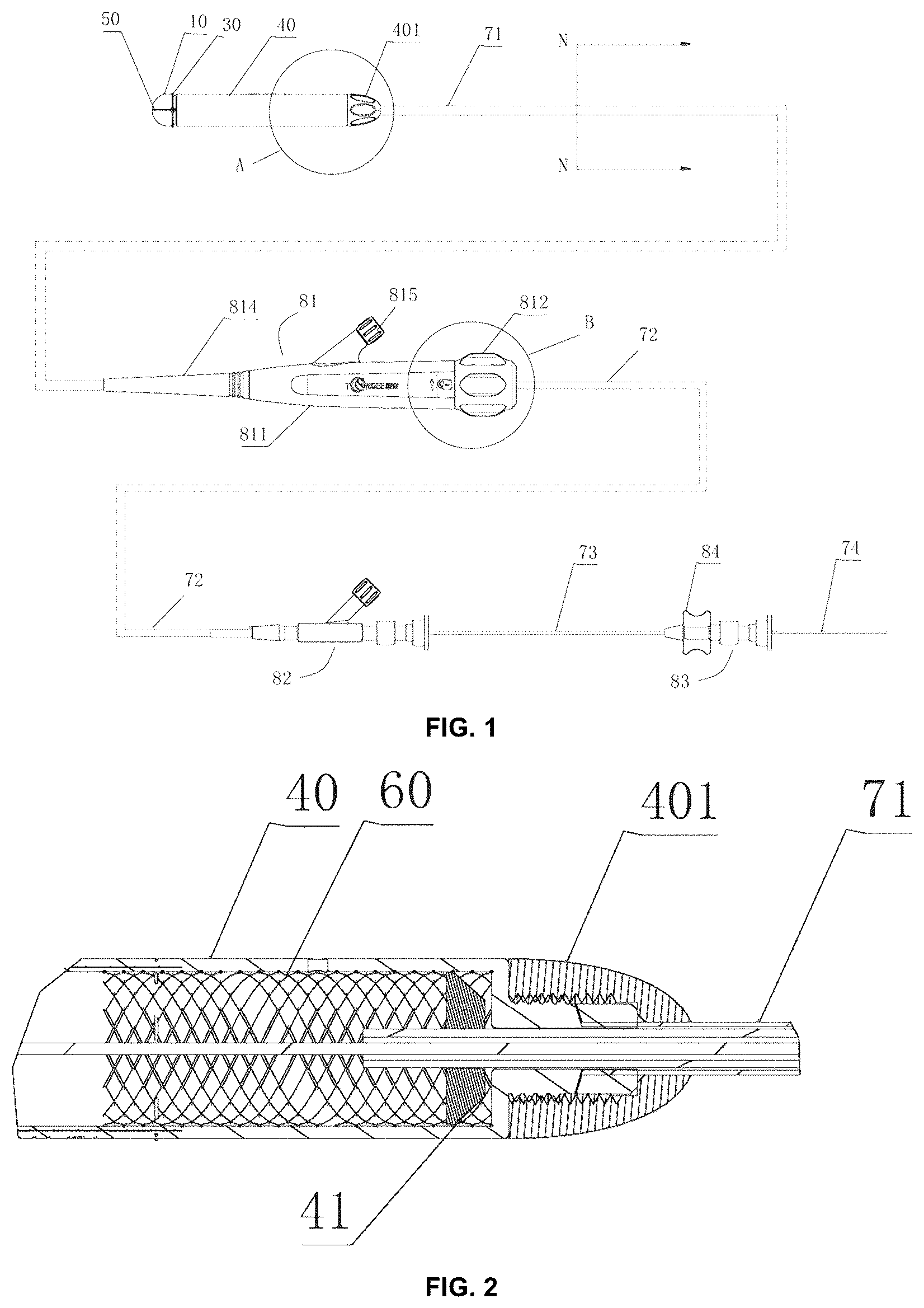 Patent US12303466 Figure 1 – Duodenum built-in jejunum cannula releasing system and a use method therefor