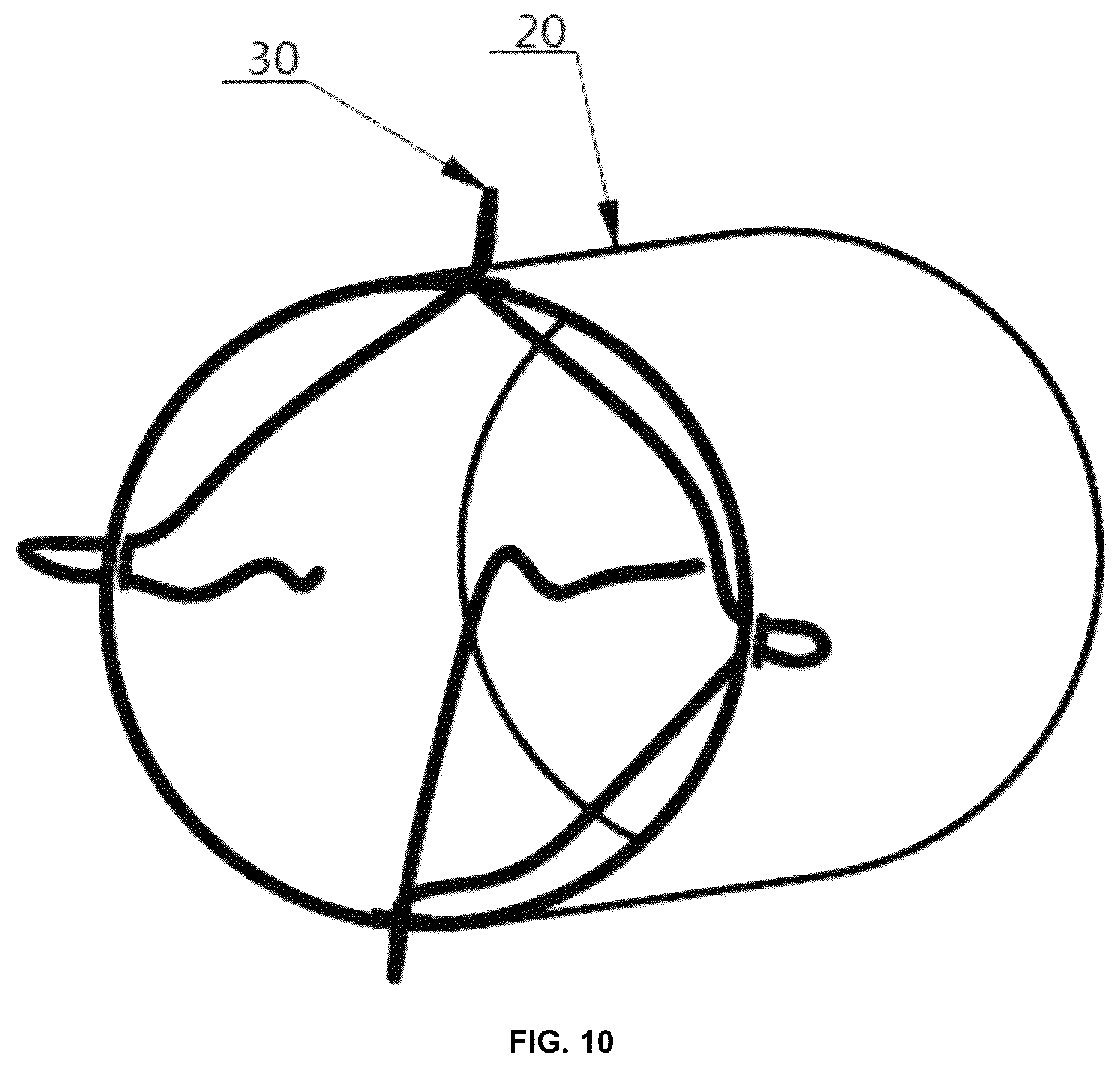 Patent US12303466 Figure 6 – Duodenum built-in jejunum cannula releasing system and a use method therefor