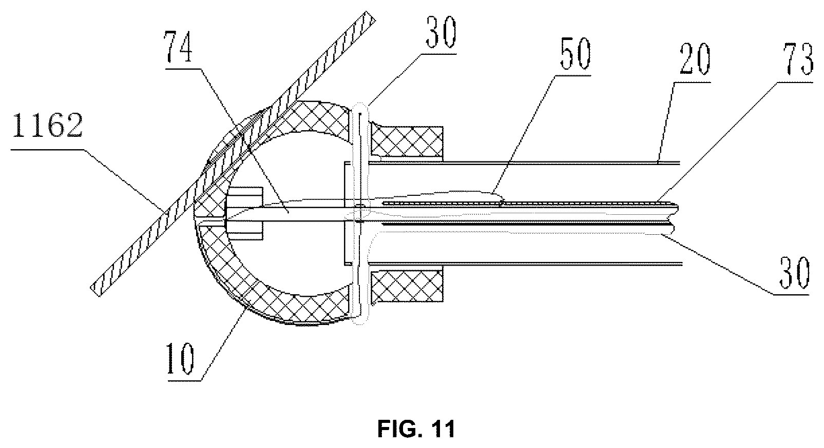 Patent US12303466 Figure 7 – Duodenum built-in jejunum cannula releasing system and a use method therefor