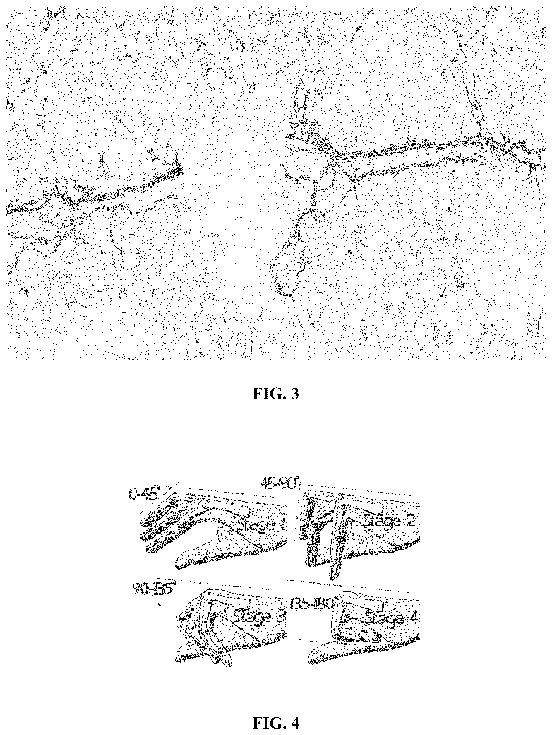 Patent US12303523 Figure 2 – Method for treating dupuytren's disease