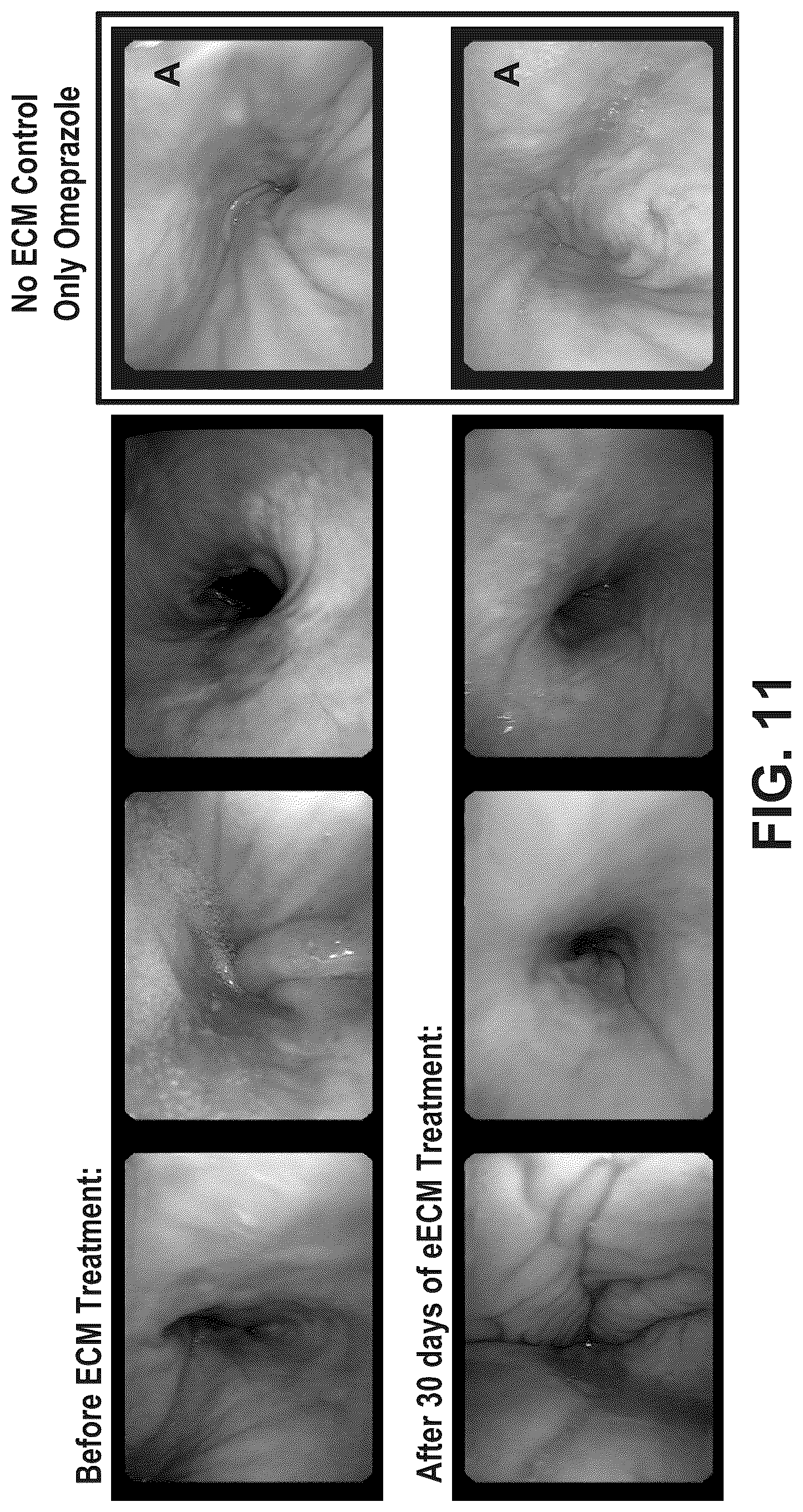 Patent US12303533 Figure 12 – ECM hydrogel for treating esophageal inflammation