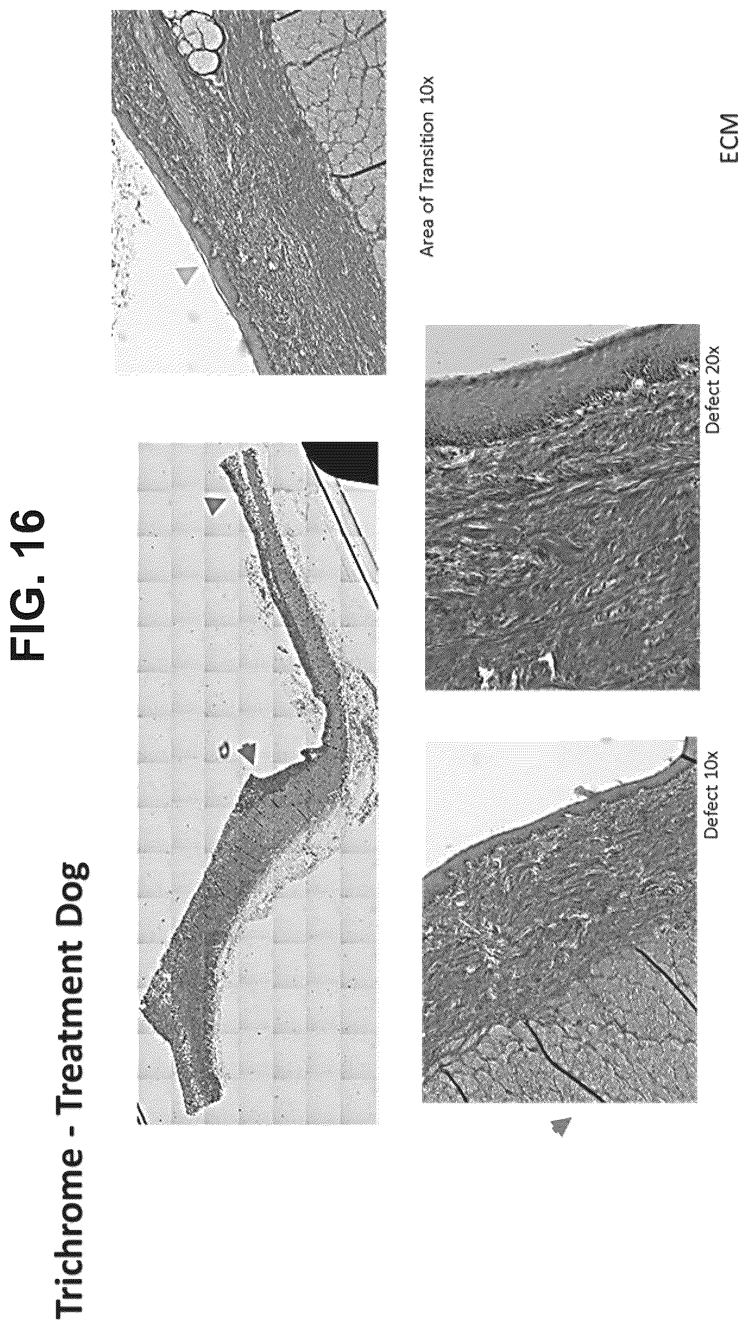 Patent US12303533 Figure 18 – ECM hydrogel for treating esophageal inflammation