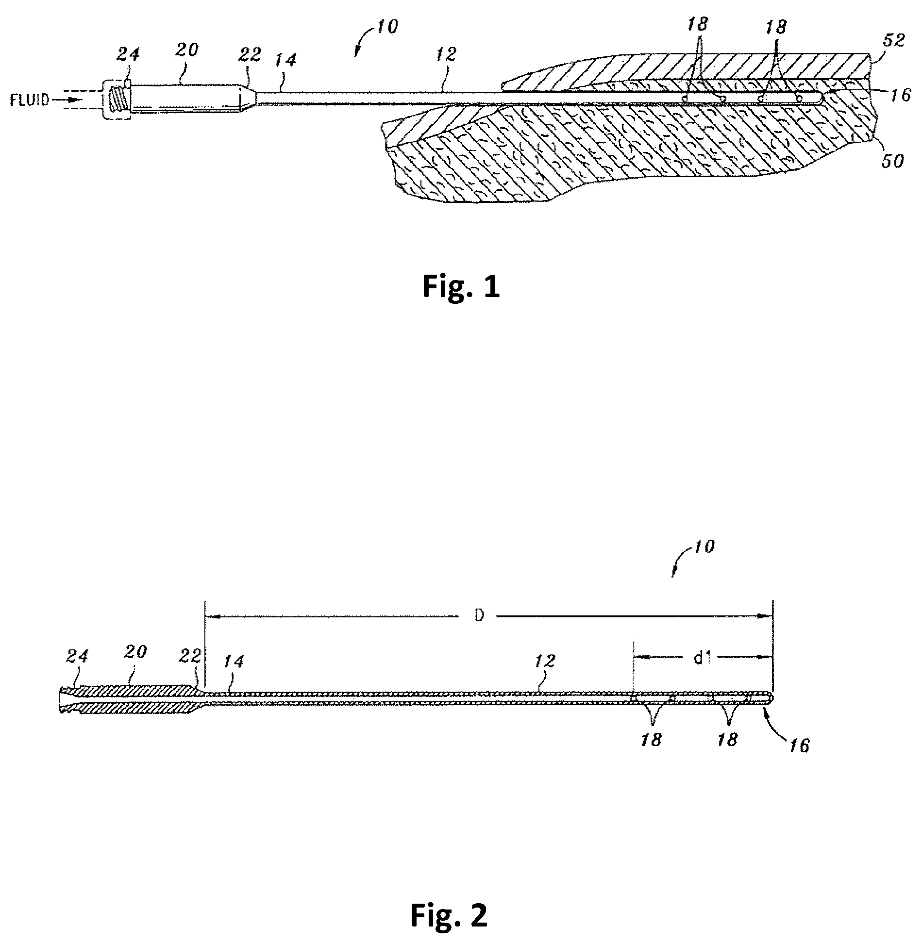 Patent US12303591 Figure 1 – Tumescent infiltration drug delivery of high subcutaneous drug concentrations with prolonged local and systemic effects and minimal local or systemic toxicity