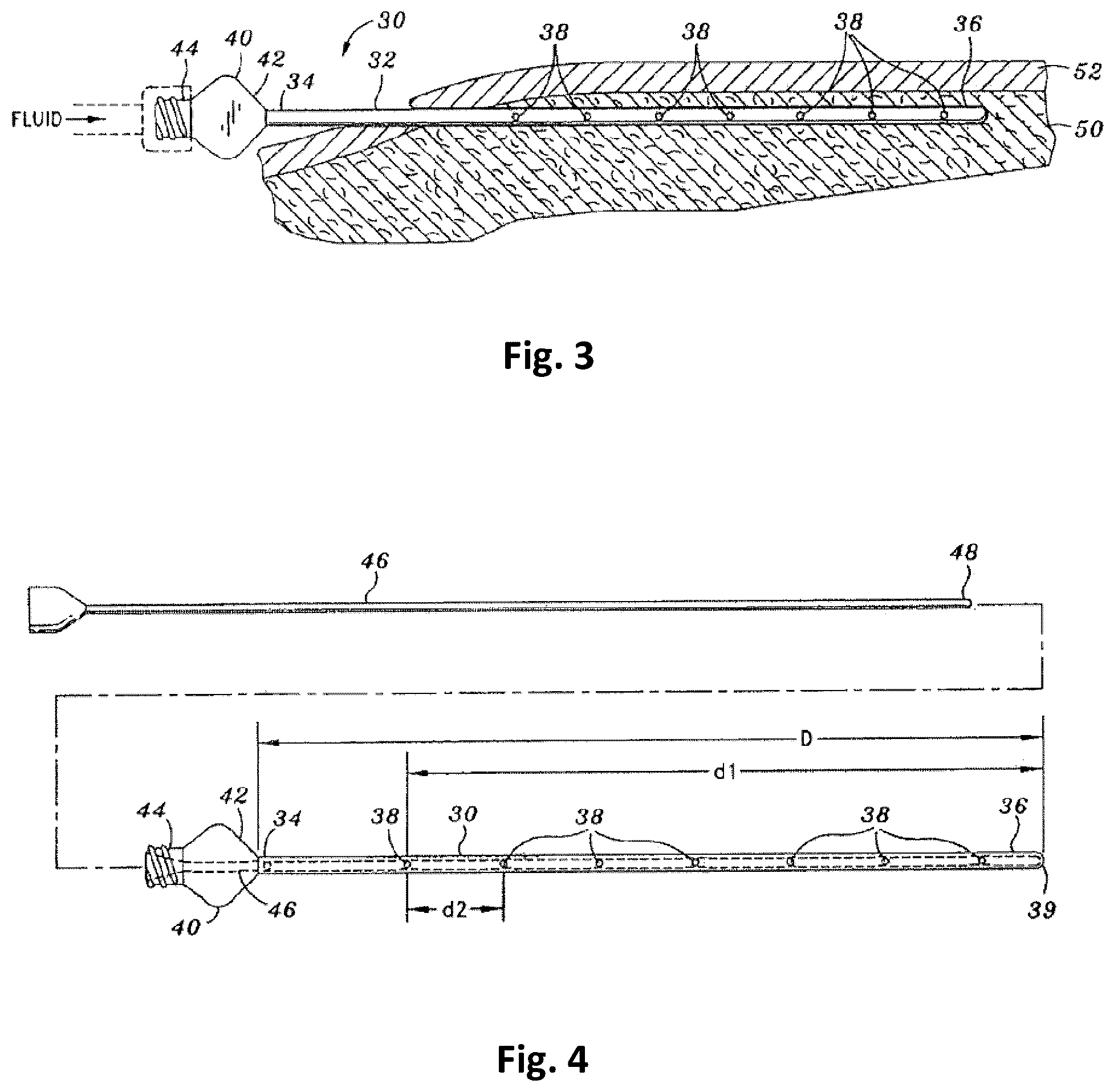 Patent US12303591 Figure 2 – Tumescent infiltration drug delivery of high subcutaneous drug concentrations with prolonged local and systemic effects and minimal local or systemic toxicity