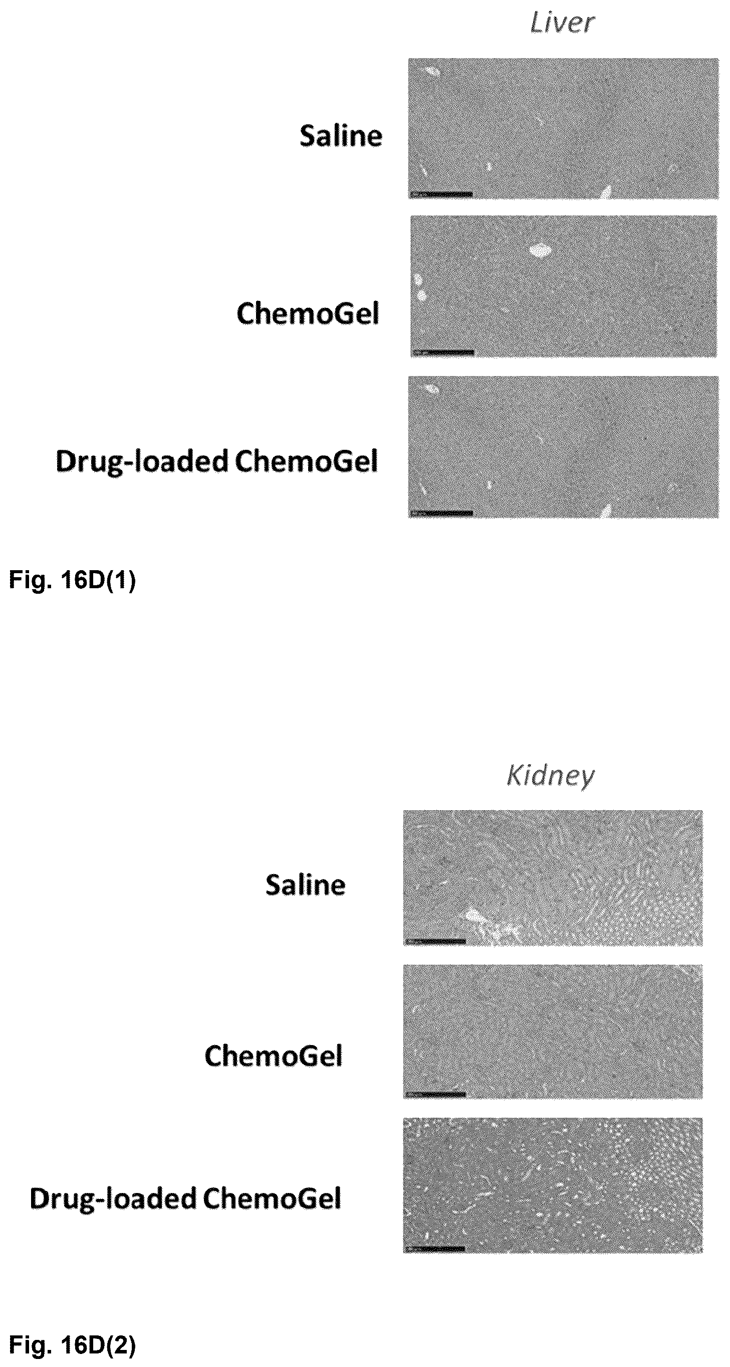 Patent US12303596 Figure 16 – Thermo-responsive hydrogel for intratumoral administration as a treatment in solid tumor cancers