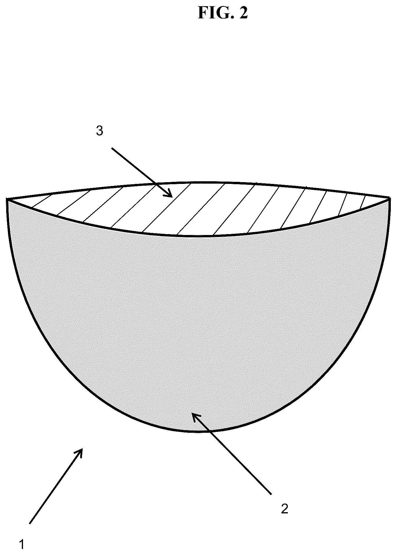 Patent US12303612 Figure 2 – Soft tissue implant pocket