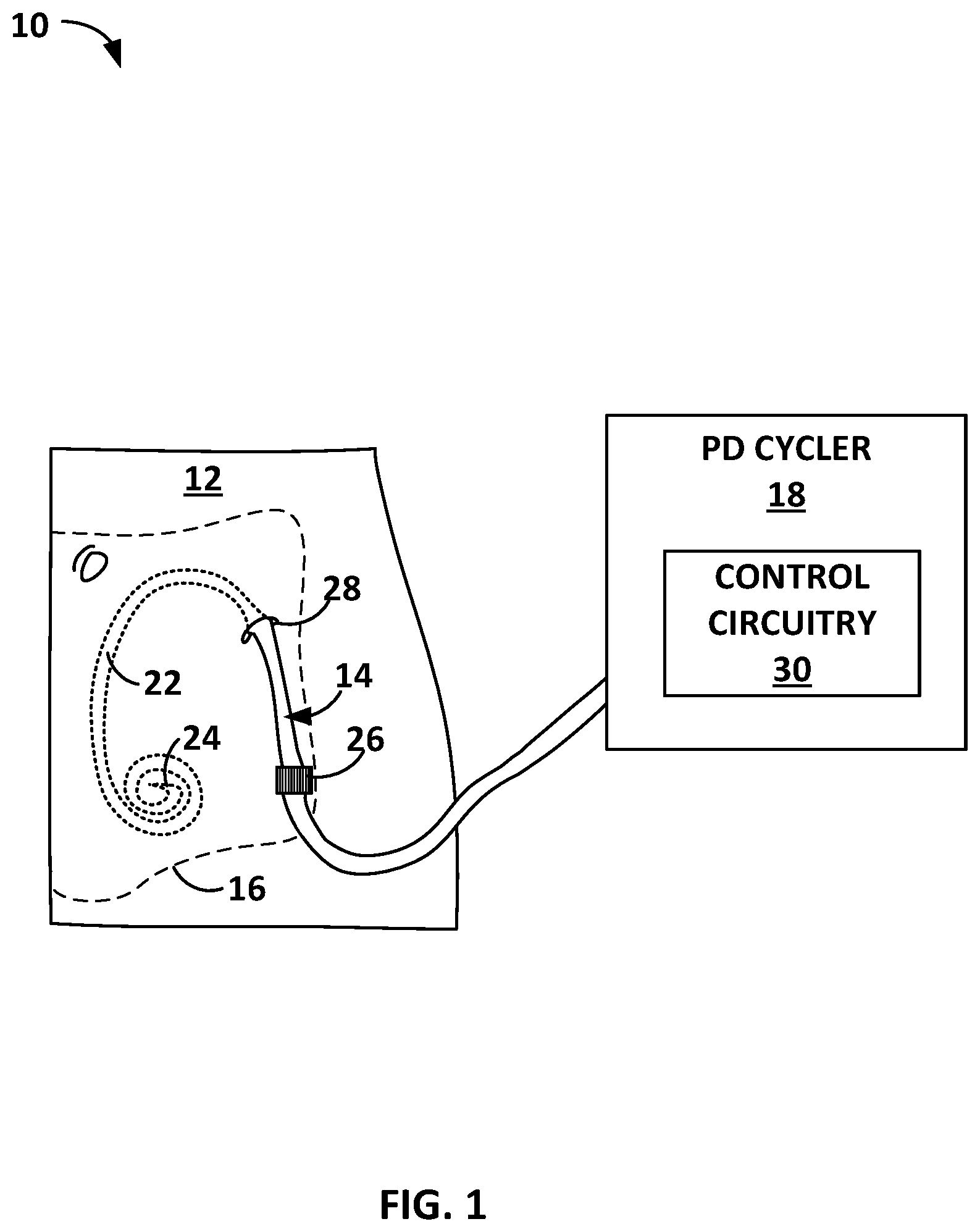 Patent US12303627 Figure 1 – Peritoneal dialysis system