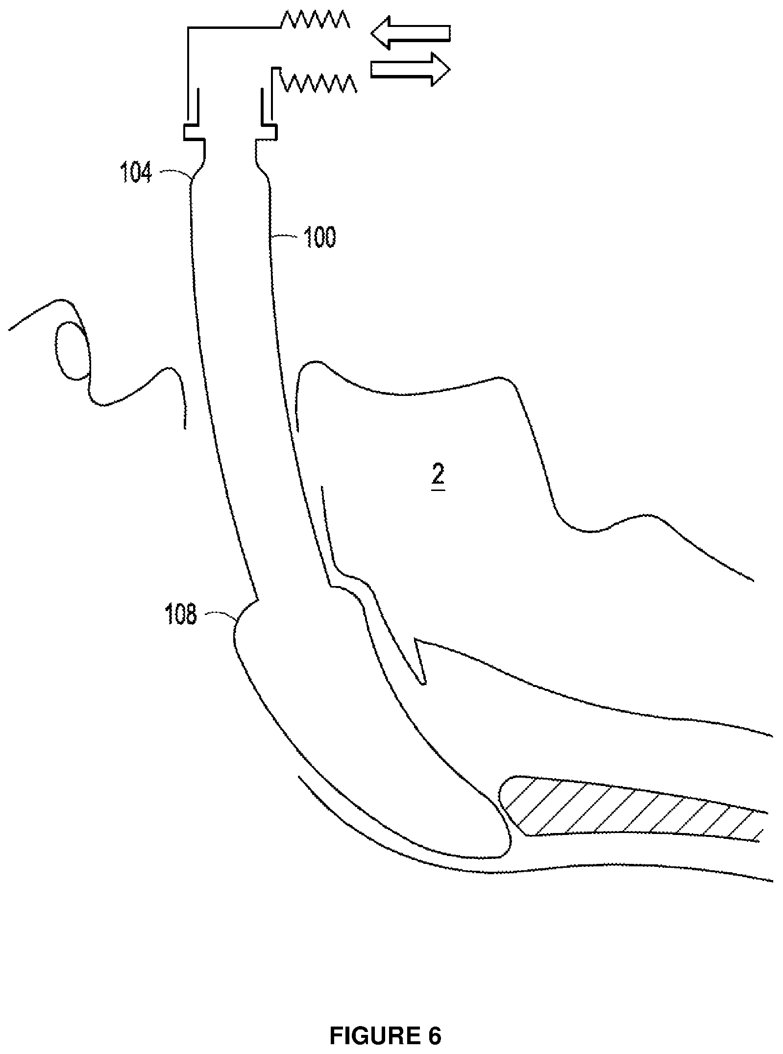 Patent US12303643 Figure 4 – Intubation apparatus and method of use