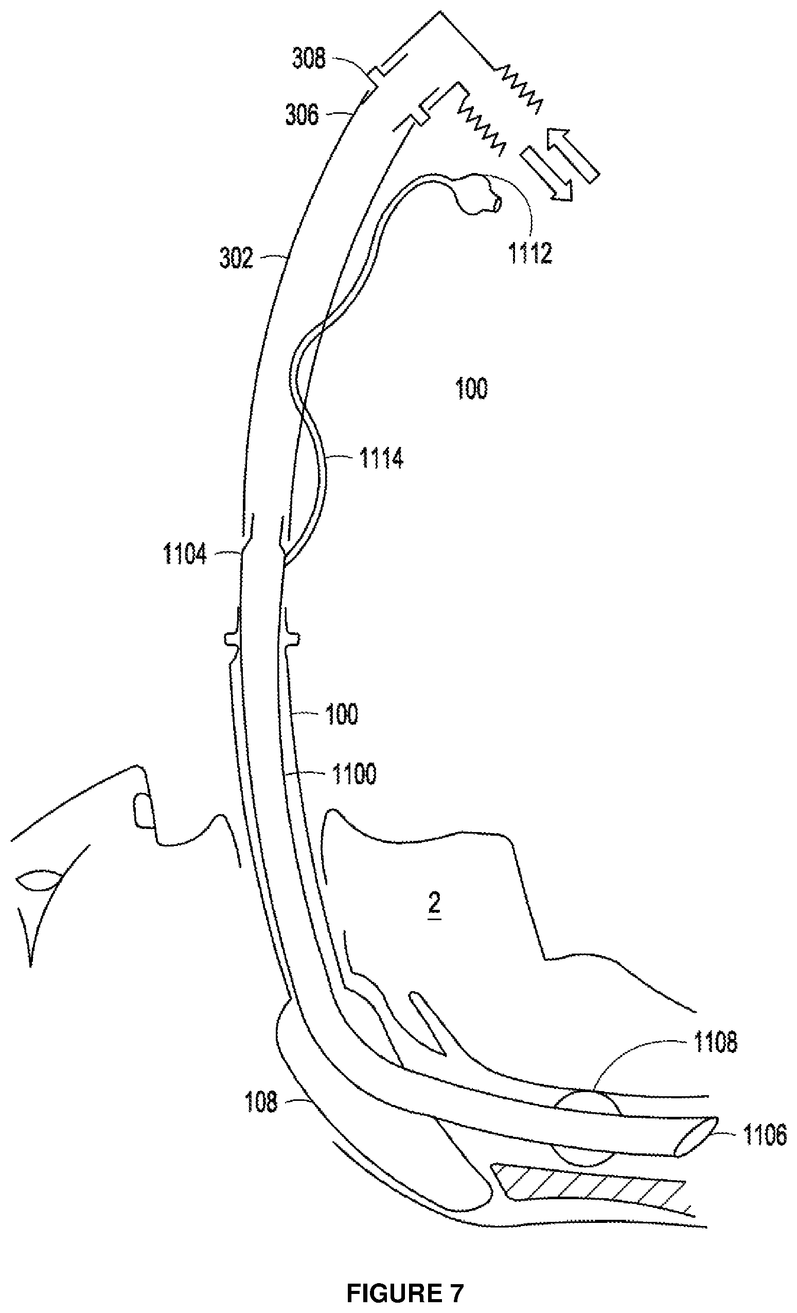Patent US12303643 Figure 5 – Intubation apparatus and method of use