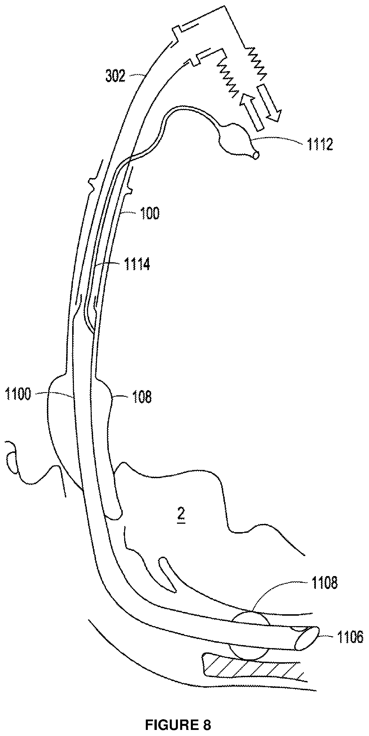 Patent US12303643 Figure 6 – Intubation apparatus and method of use