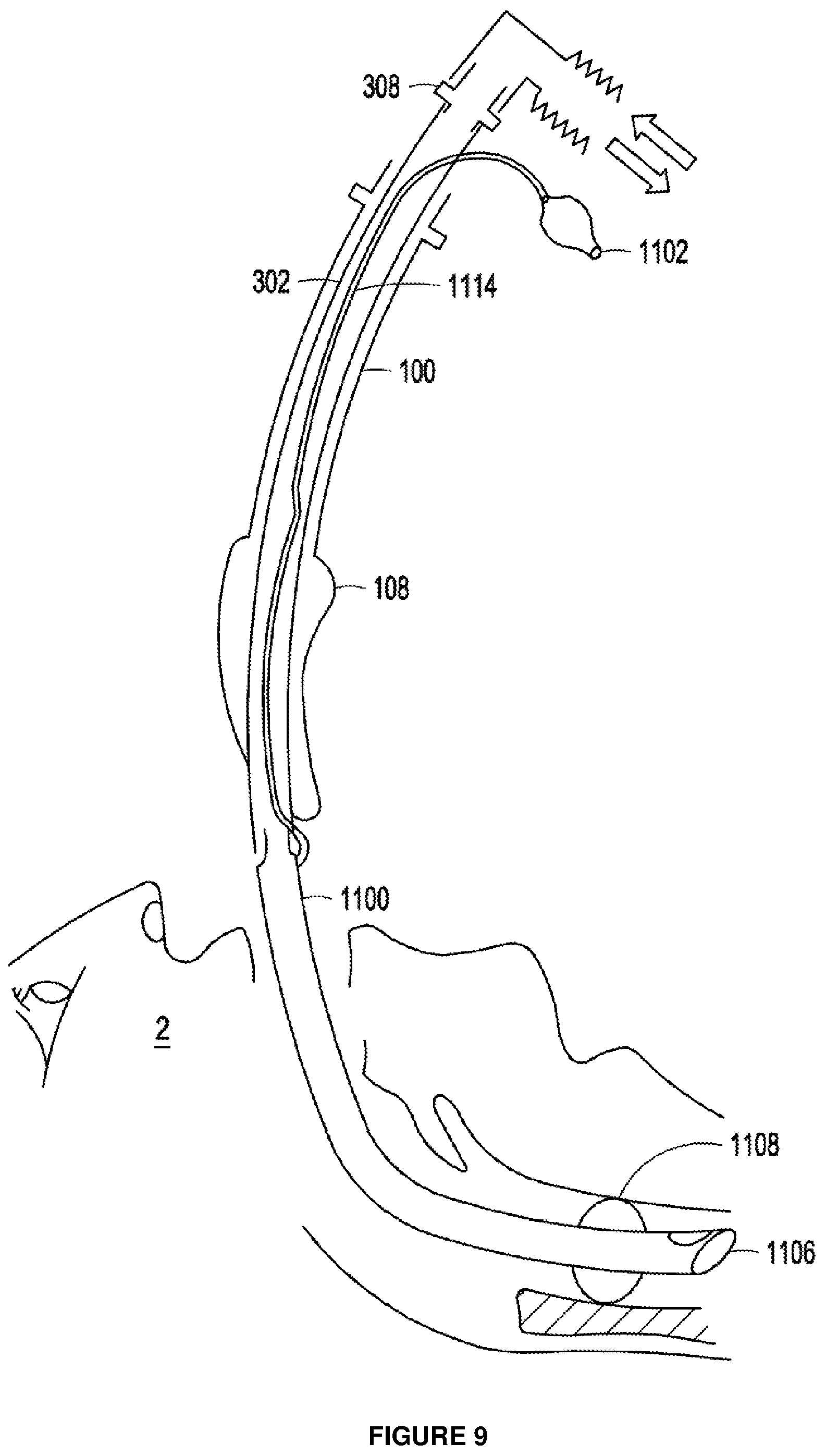 Patent US12303643 Figure 7 – Intubation apparatus and method of use