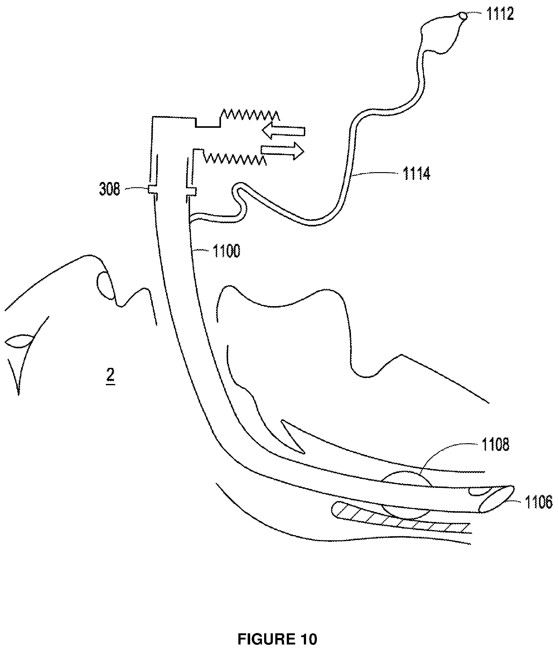Patent US12303643 Figure 8 – Intubation apparatus and method of use