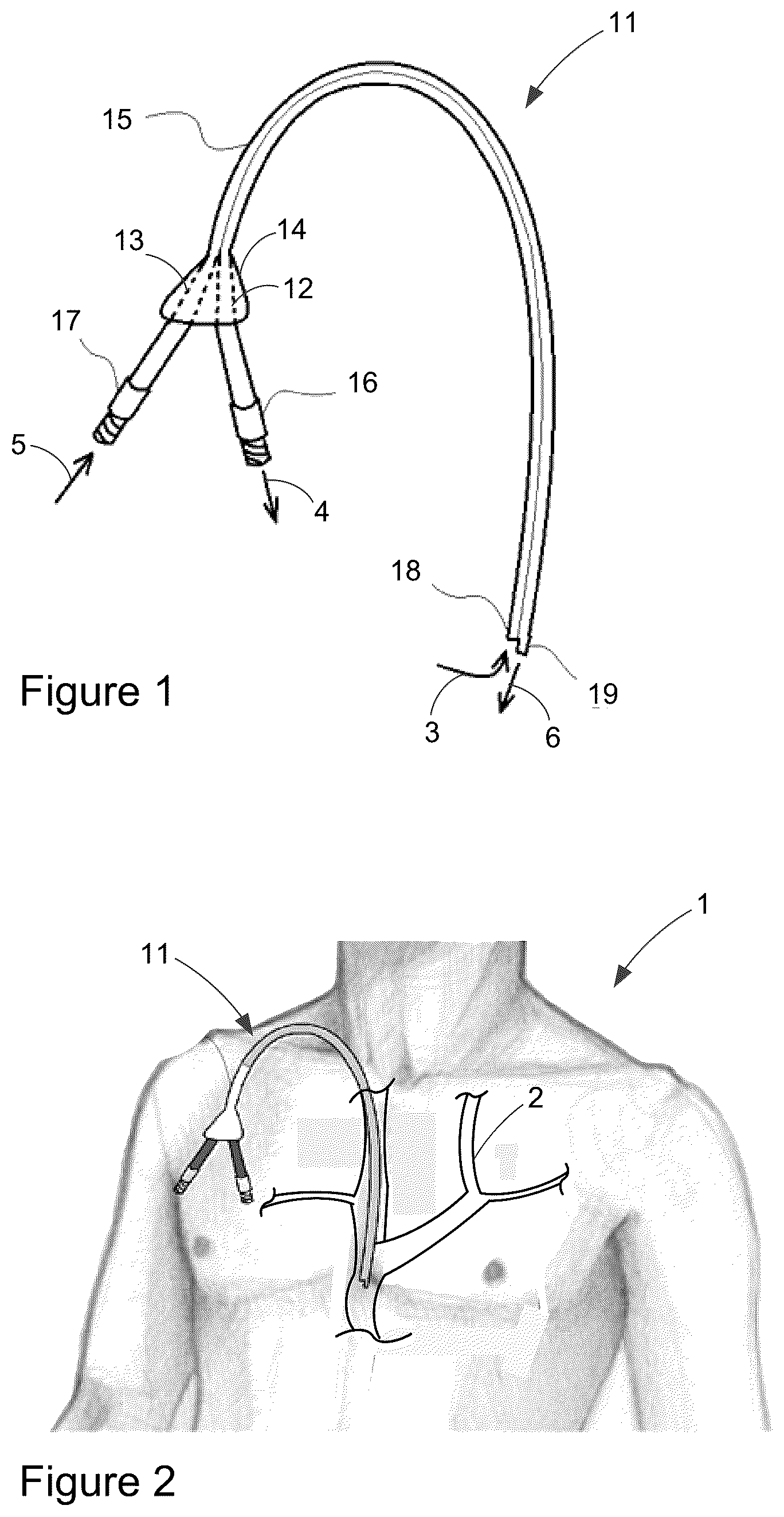 Patent US12303649 Figure 1 – Catheter clearance device and method of use