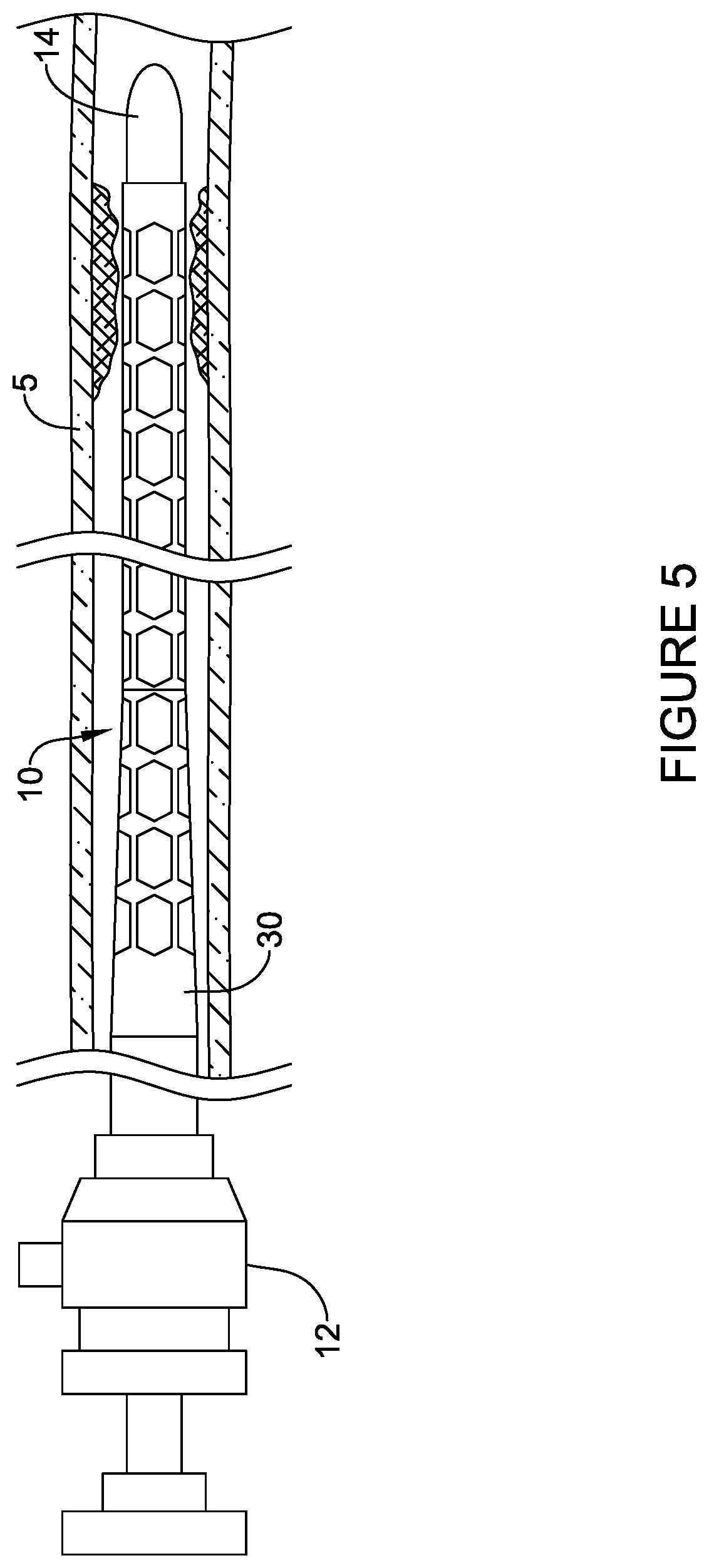 Patent US12303651 Figure 7 – Fully compliant large bore expandable sheath