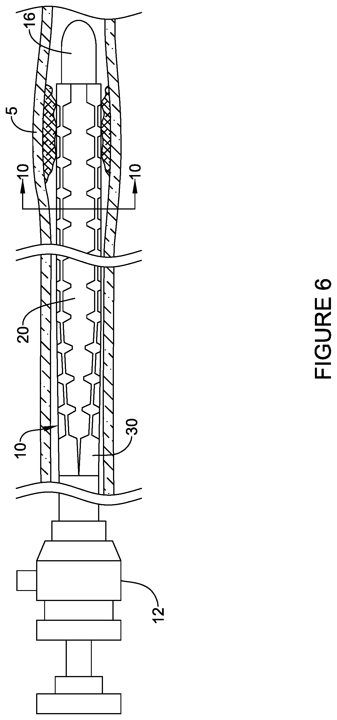 Patent US12303651 Figure 8 – Fully compliant large bore expandable sheath