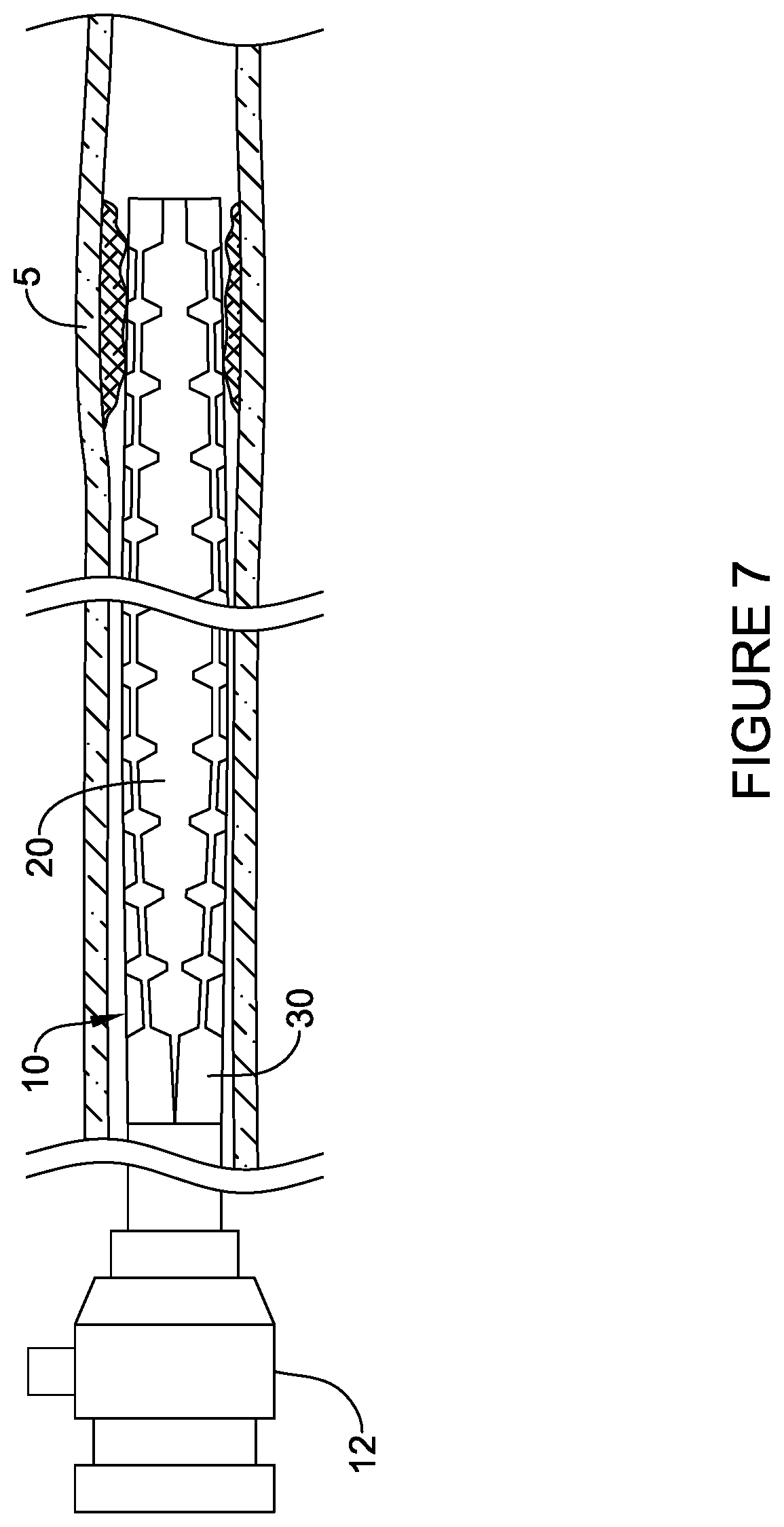 Patent US12303651 Figure 9 – Fully compliant large bore expandable sheath