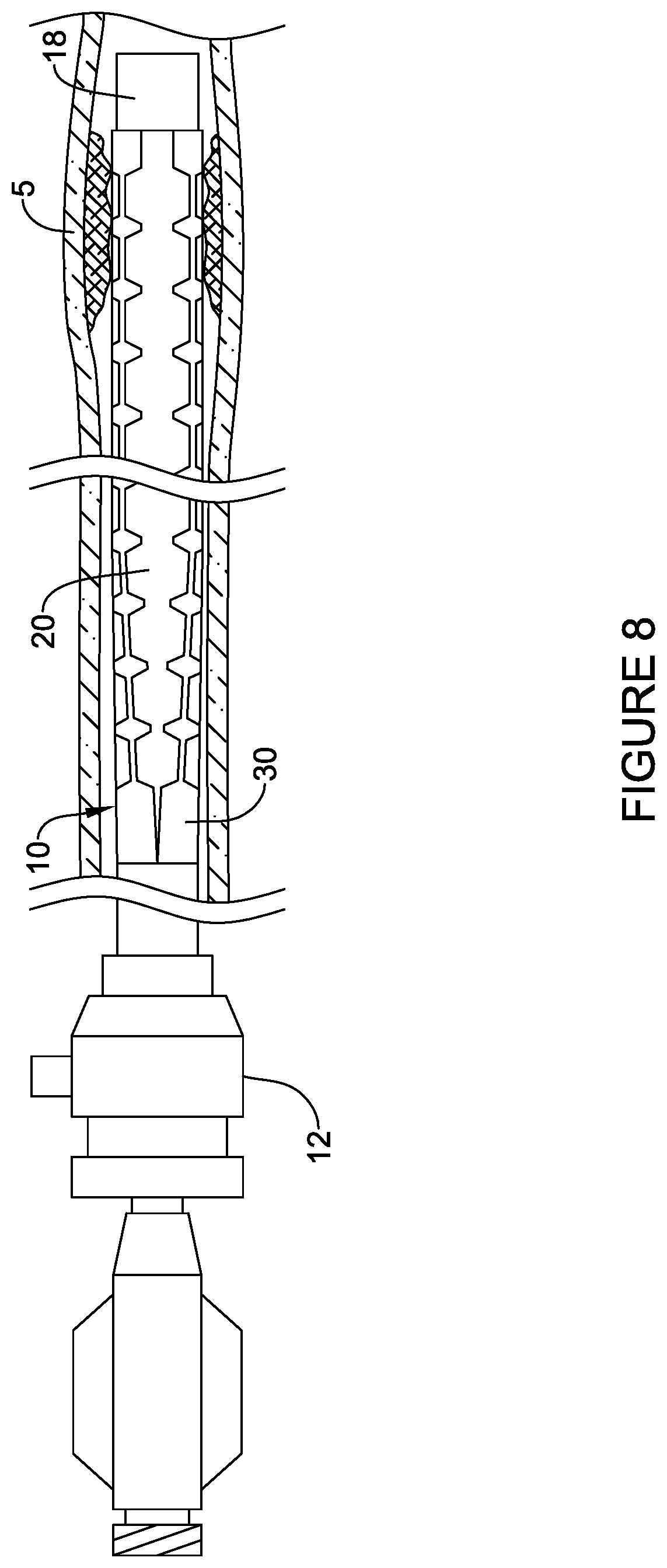 Patent US12303651 Figure 10 – Fully compliant large bore expandable sheath