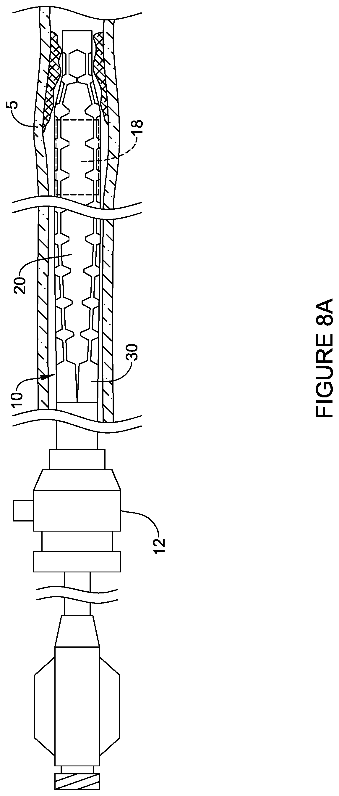 Patent US12303651 Figure 11 – Fully compliant large bore expandable sheath