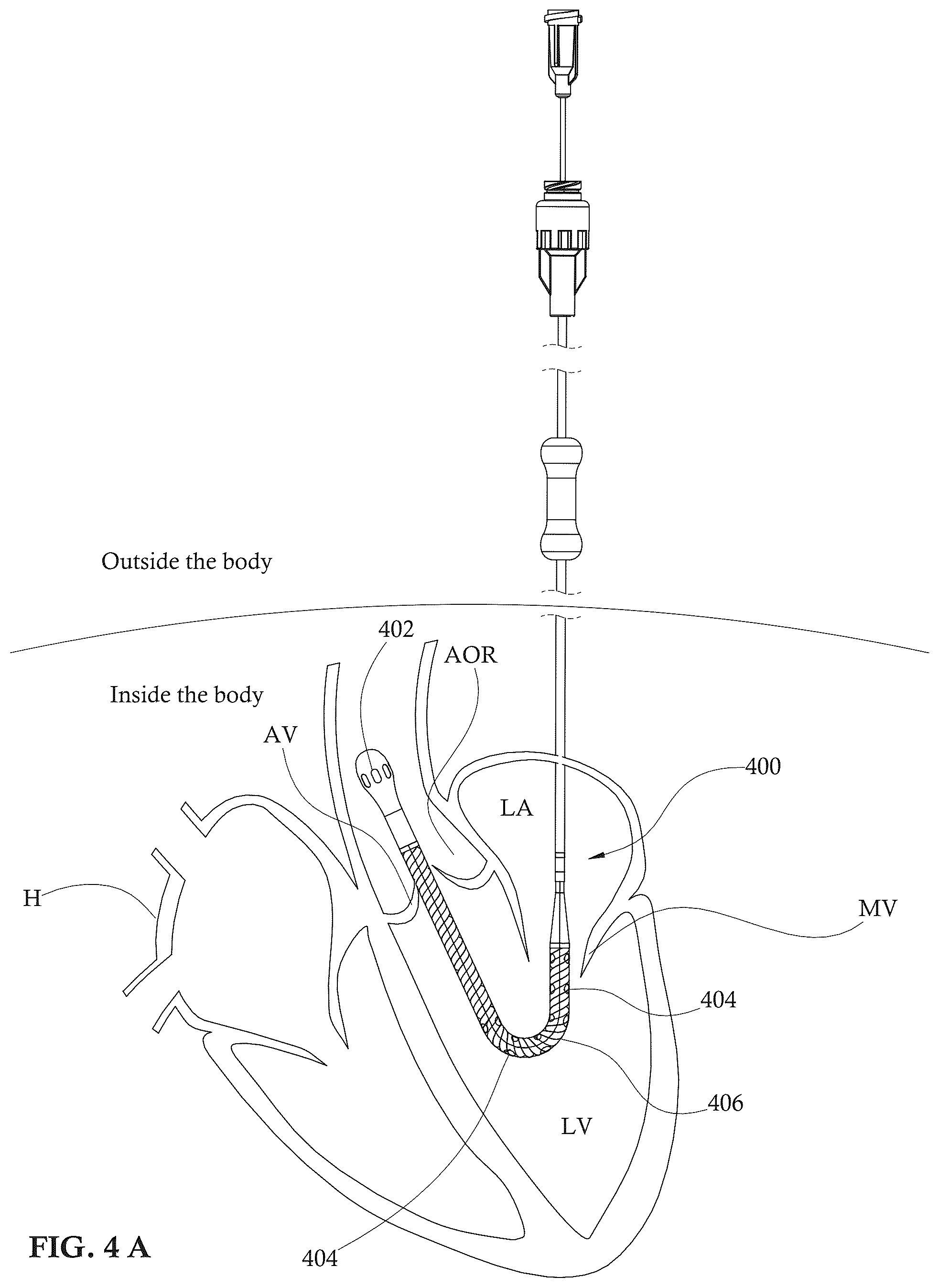 Patent US12303679 Figure 4 – Expandable mechanical hemodynamic support systems, devices, and methods
