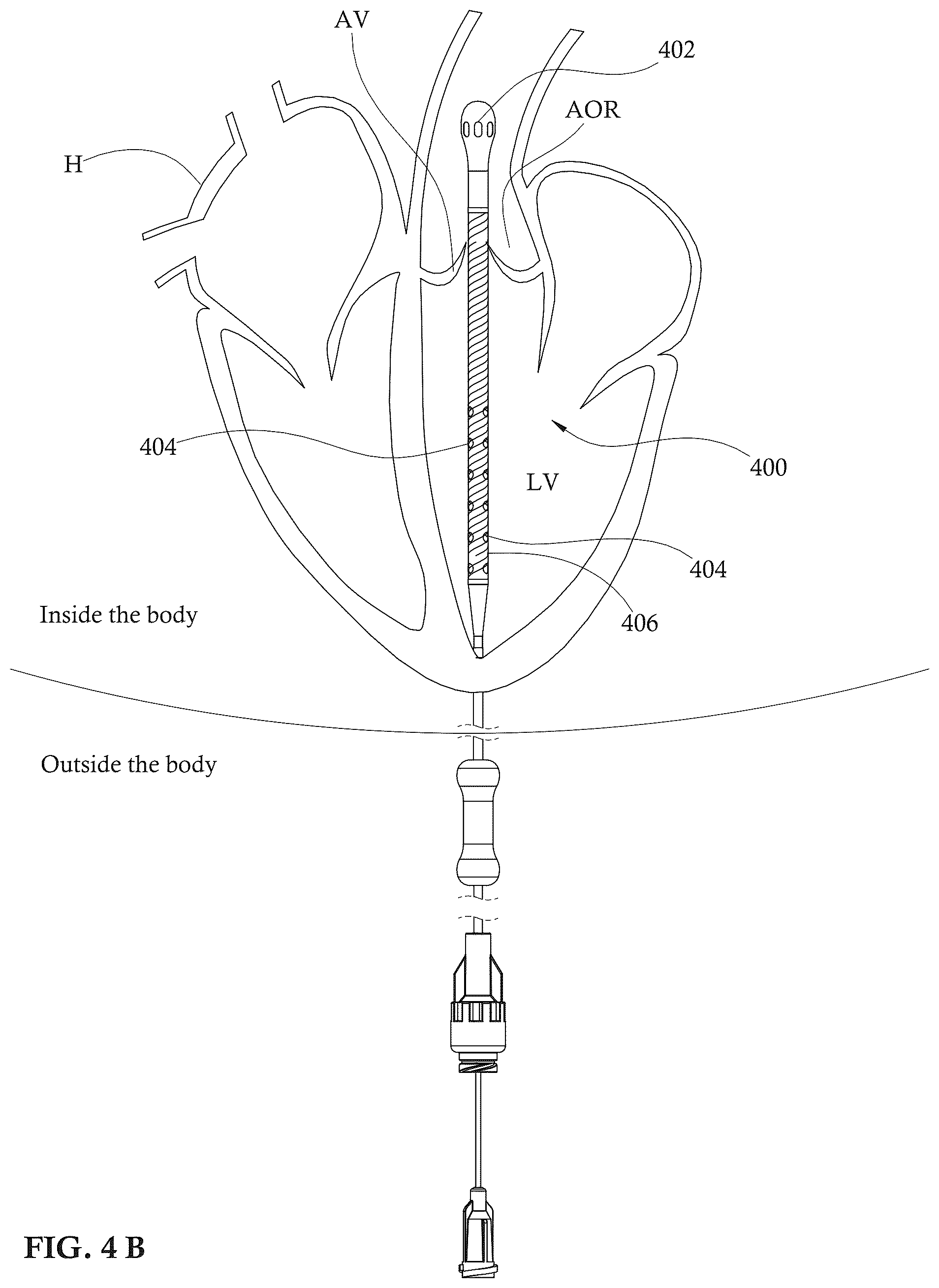 Patent US12303679 Figure 5 – Expandable mechanical hemodynamic support systems, devices, and methods