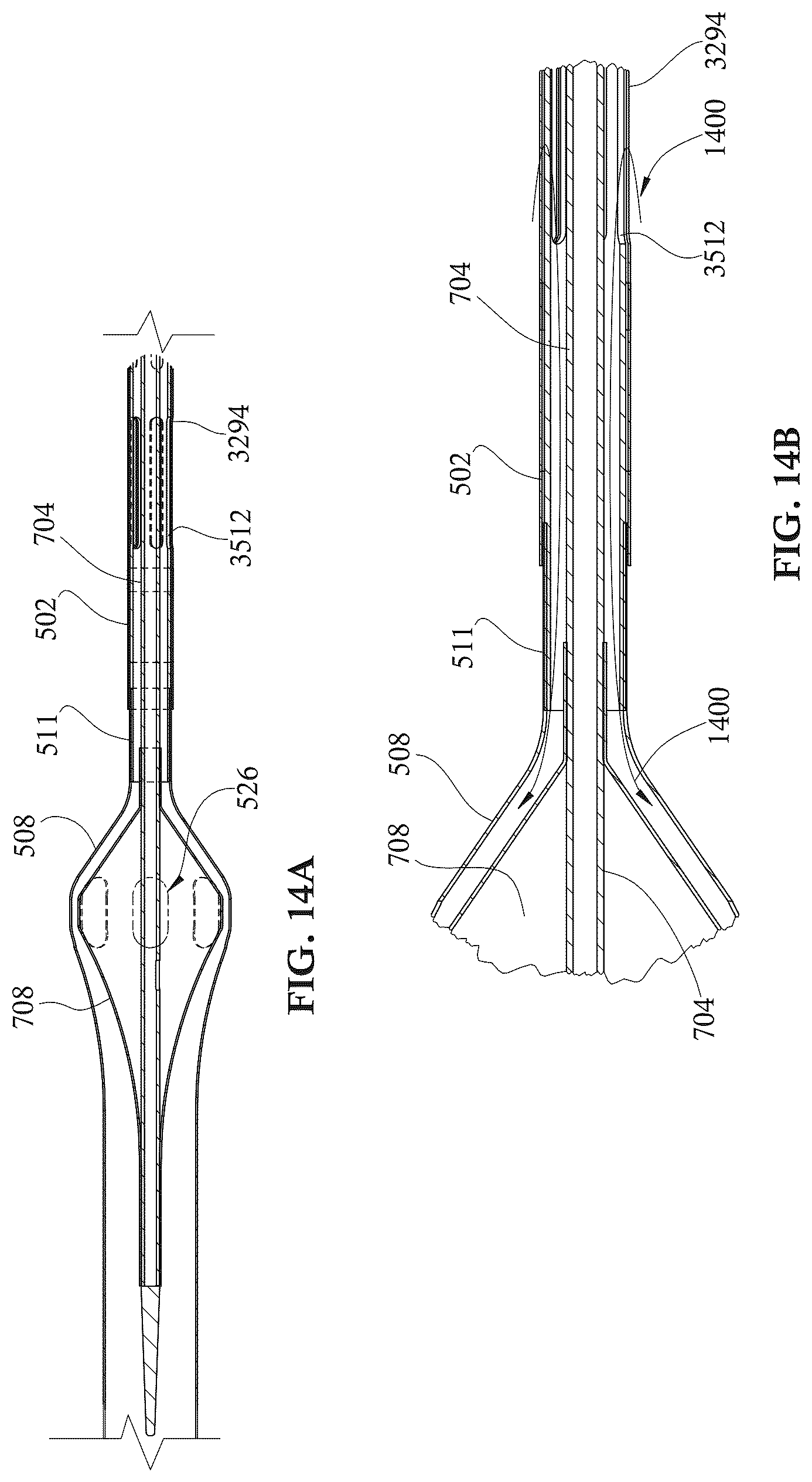 Patent US12303679 Figure 15 – Expandable mechanical hemodynamic support systems, devices, and methods
