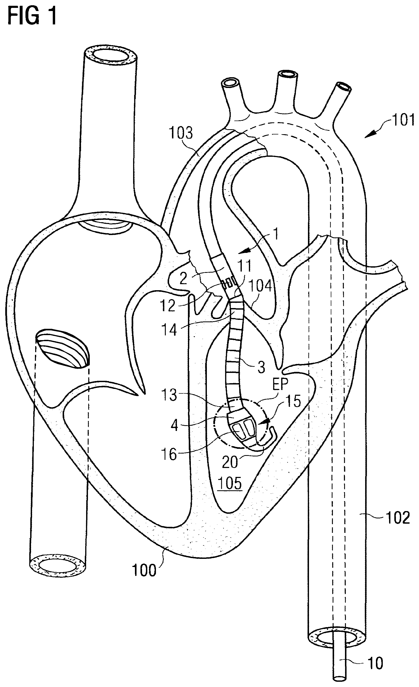 Patent US12303680 Figure 1 – Blood pump