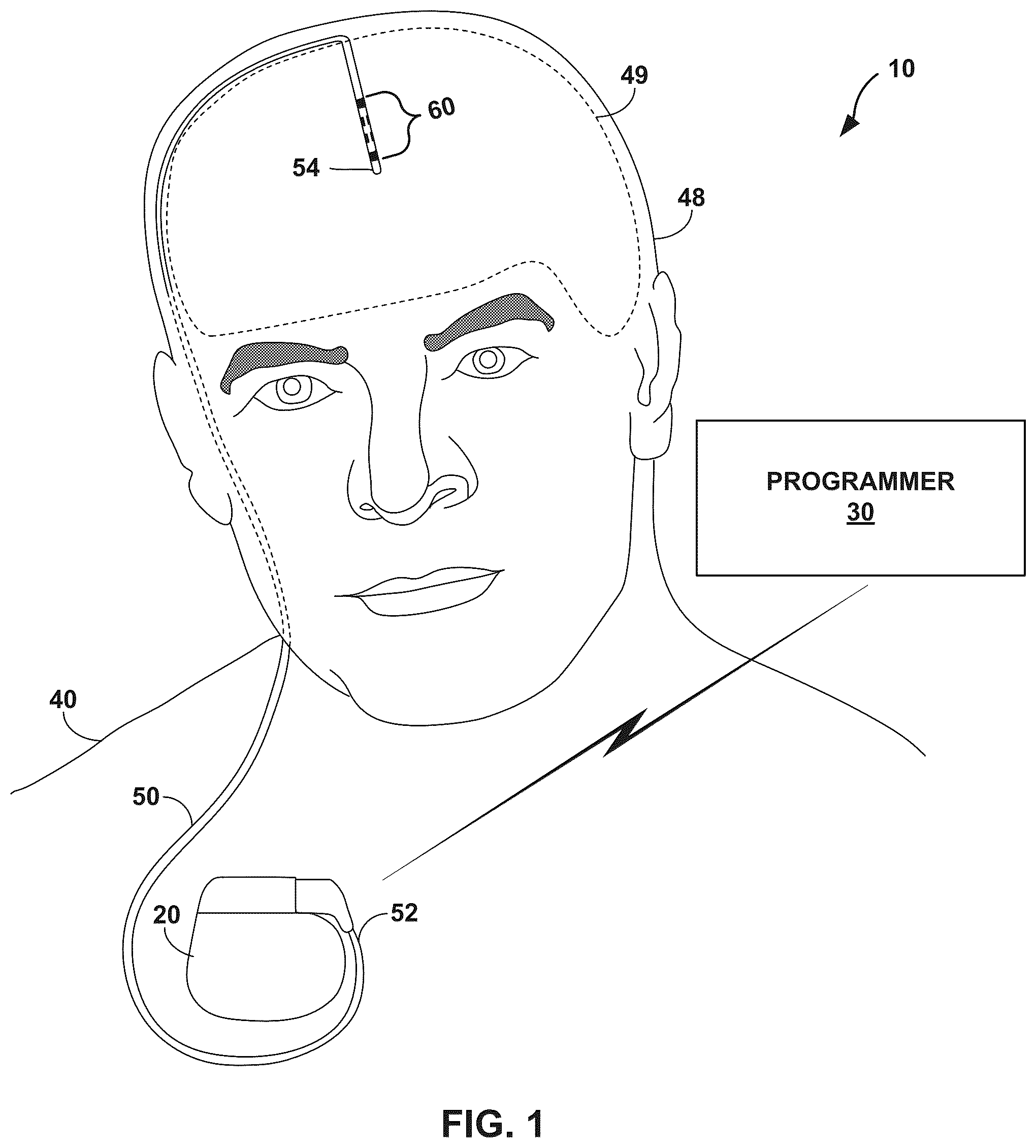 Patent US12303682 — Medical lead with segmented electrodes — Figure 1