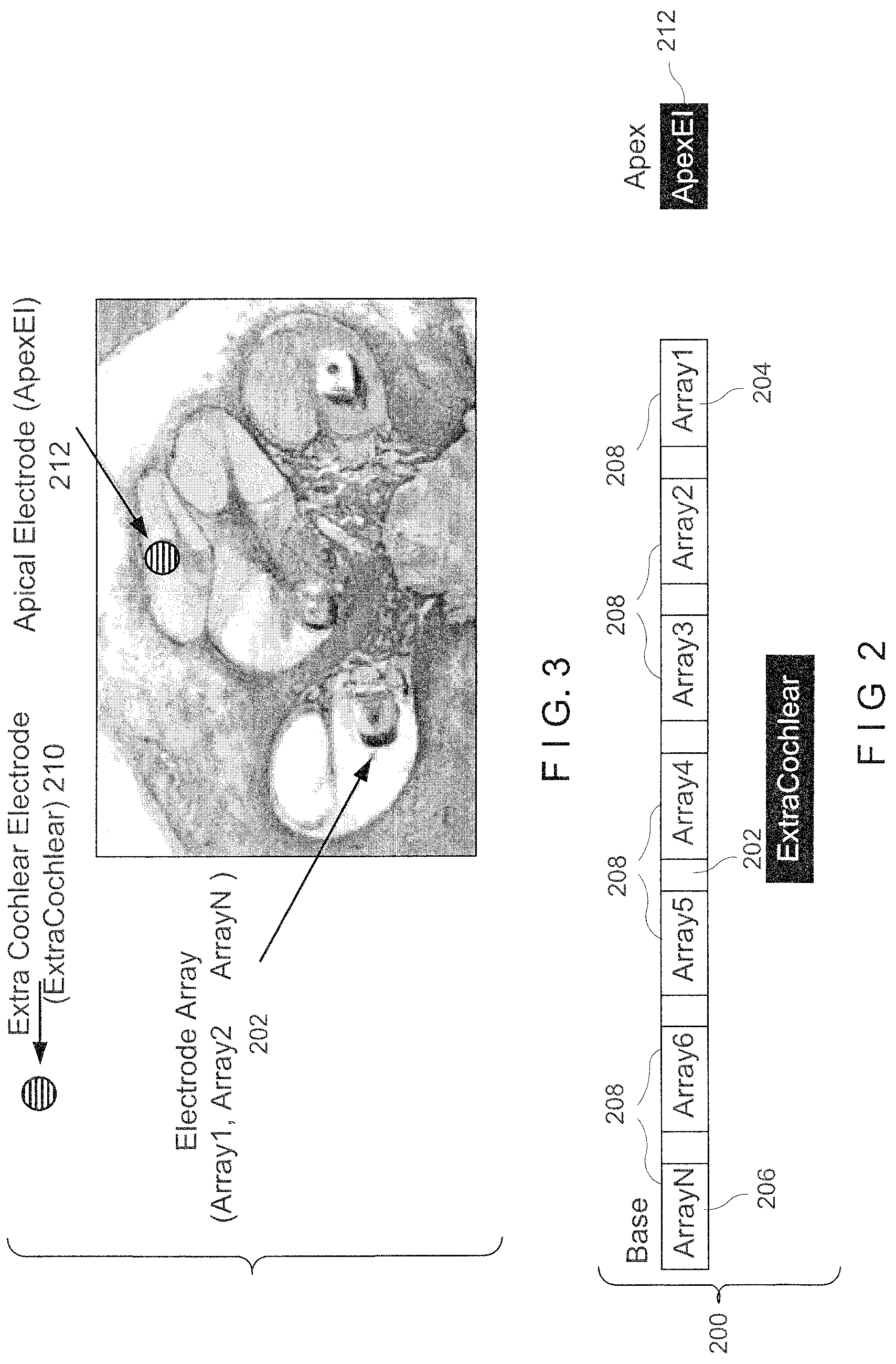 Patent US12303683 Figure 2 – Method and device for providing stimulation to a cochlea