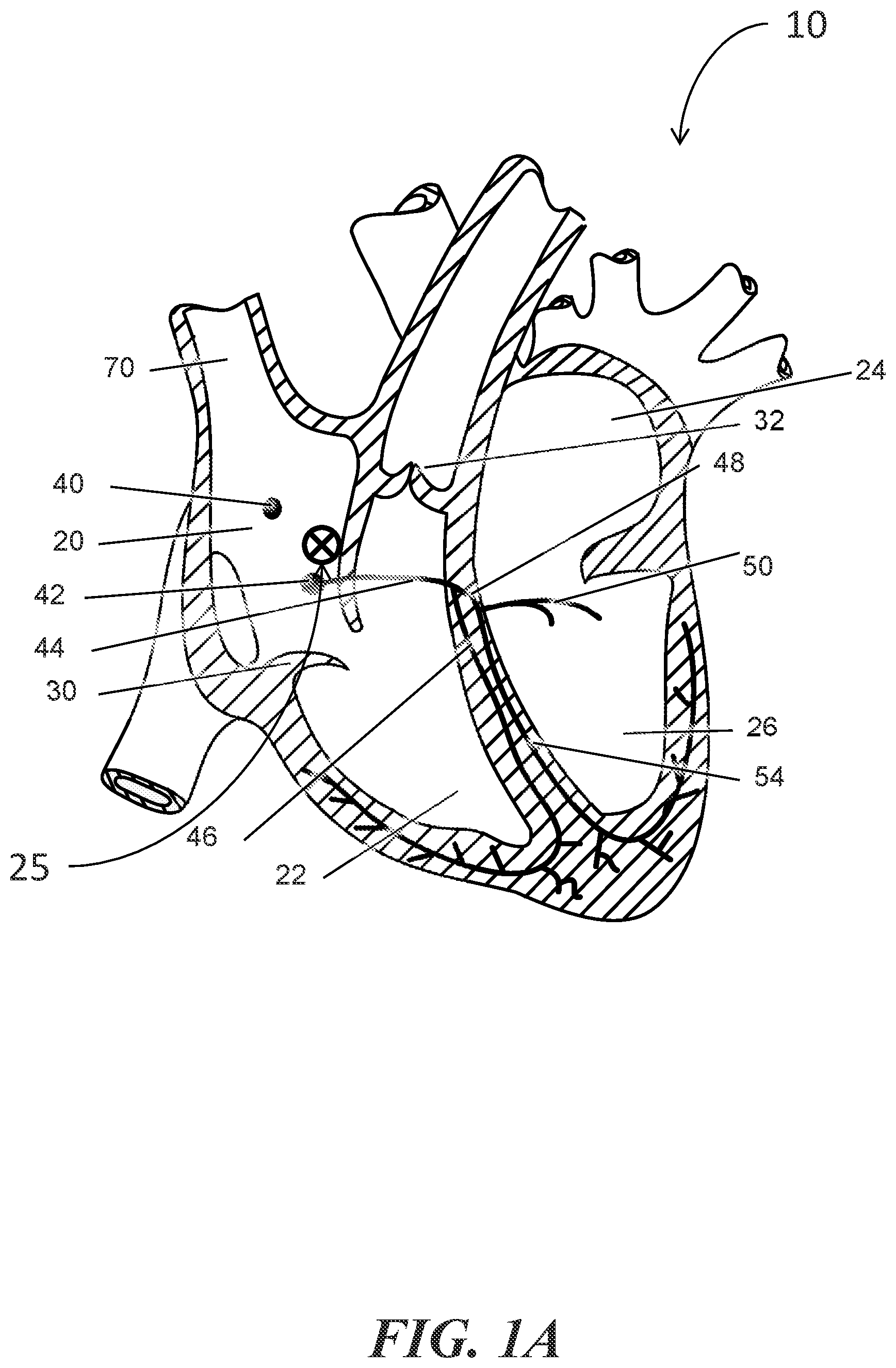 Patent US12303684 Figure 1 – Transcoronary sinus pacing of posteroseptal left ventricular base
