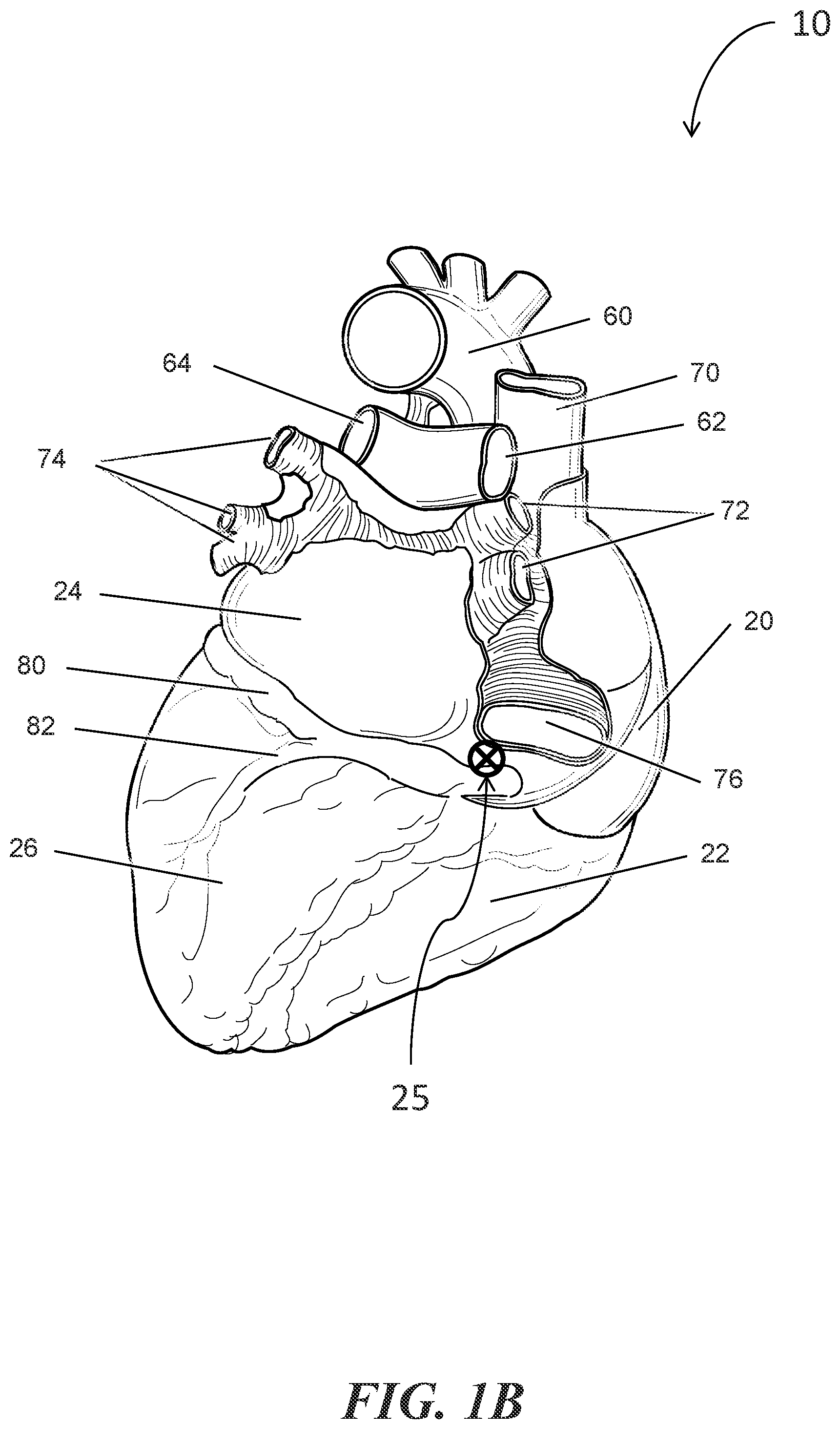 Patent US12303684 Figure 2 – Transcoronary sinus pacing of posteroseptal left ventricular base
