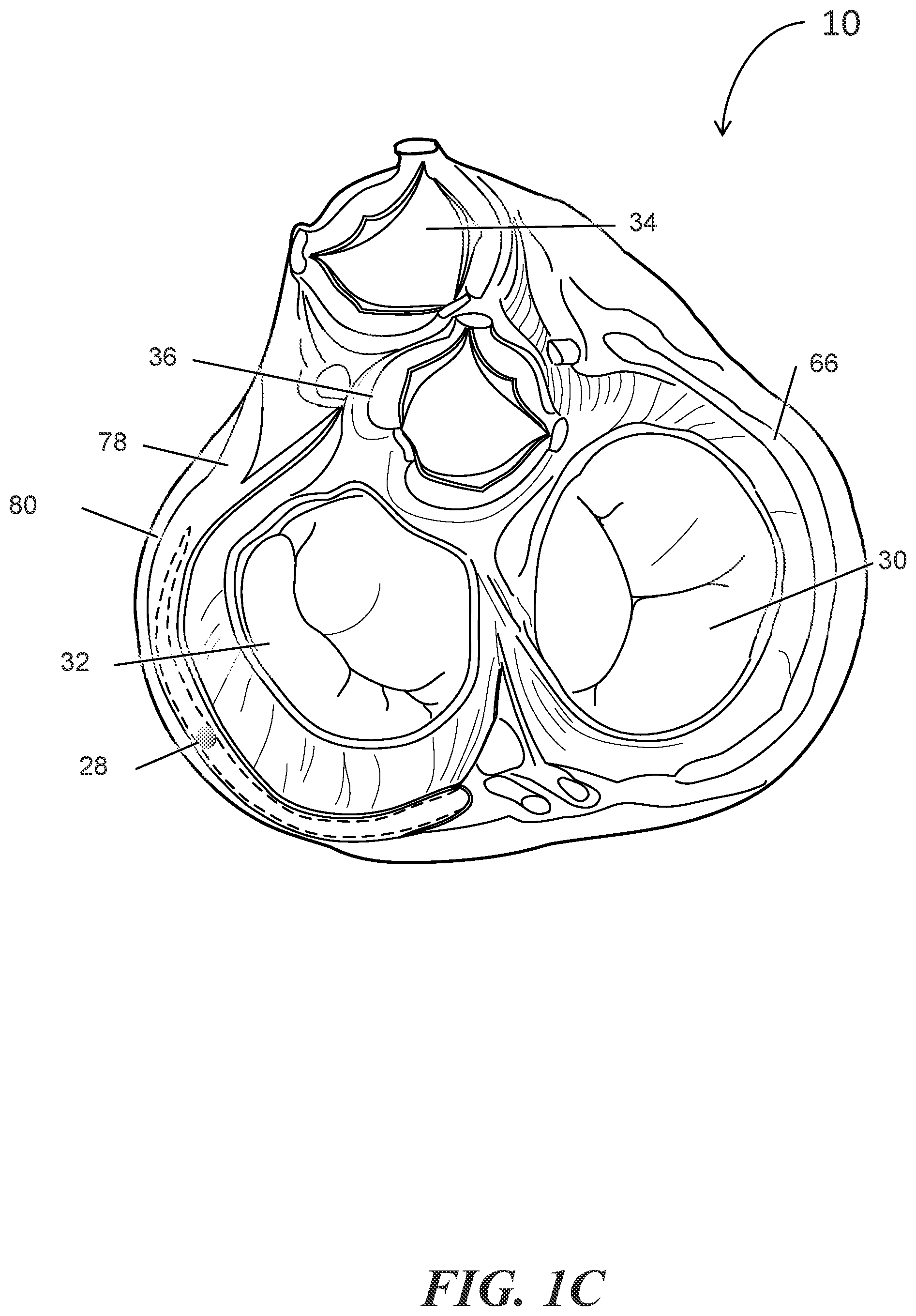 Patent US12303684 Figure 3 – Transcoronary sinus pacing of posteroseptal left ventricular base