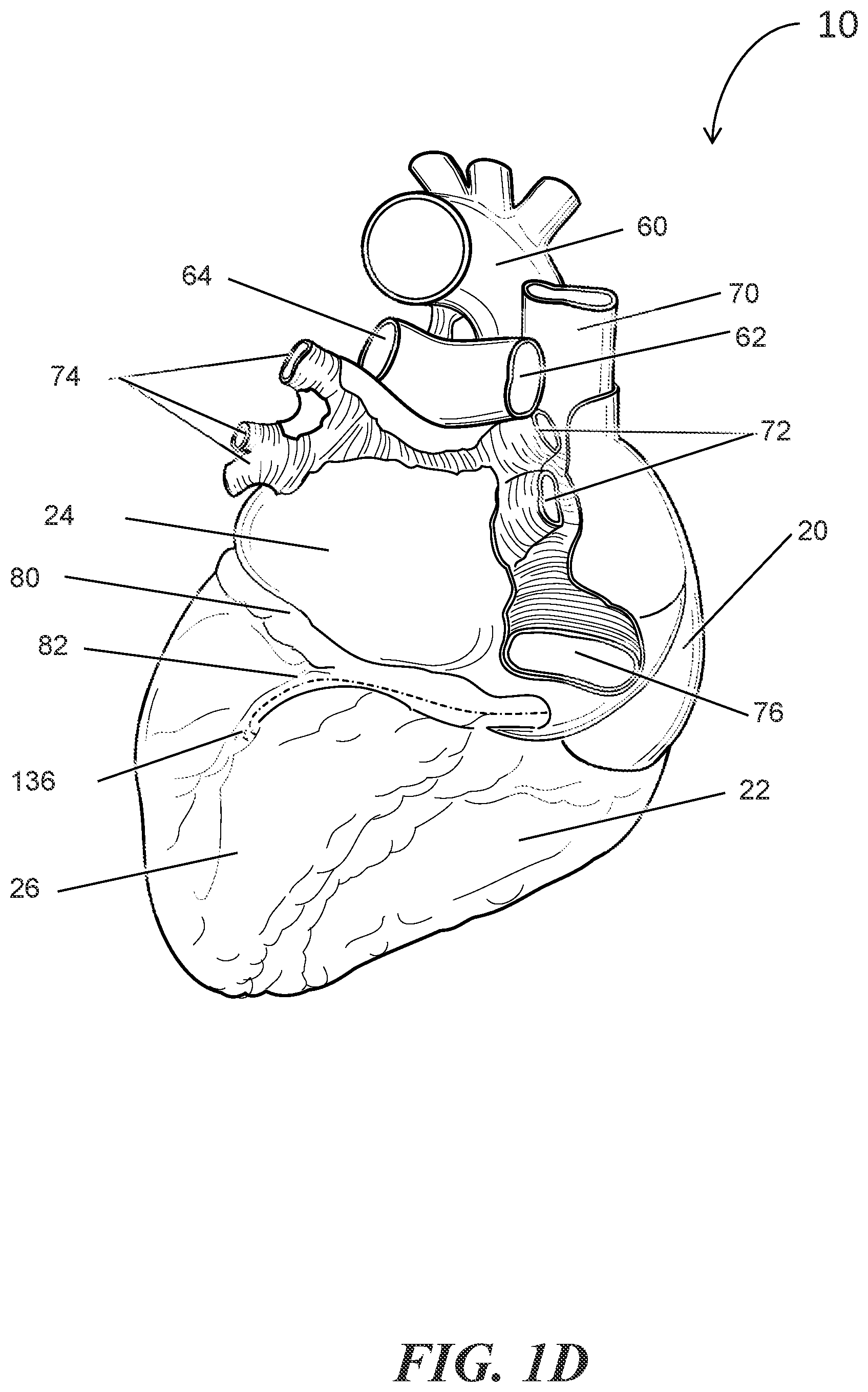 Patent US12303684 Figure 4 – Transcoronary sinus pacing of posteroseptal left ventricular base