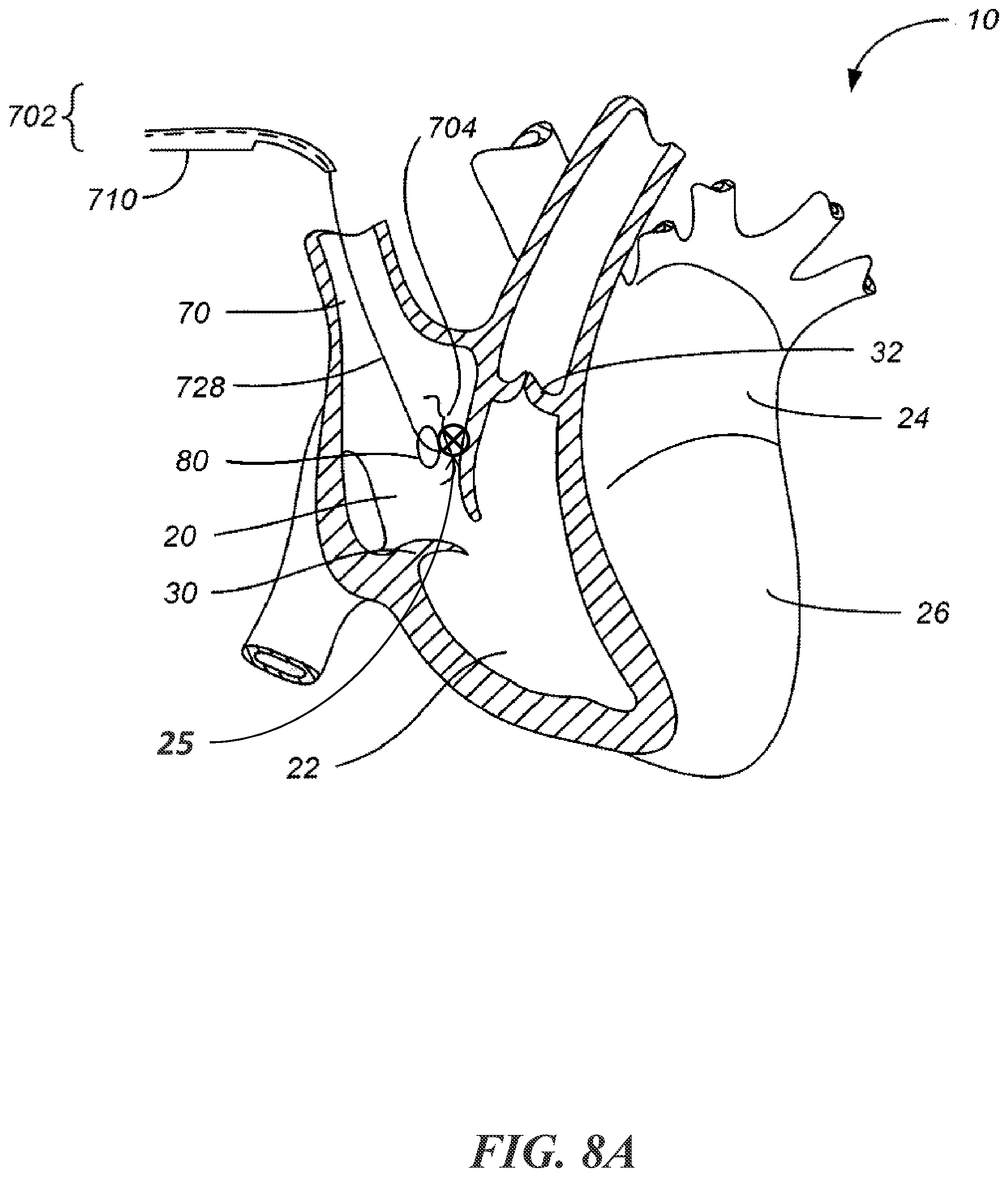 Patent US12303684 Figure 13 – Transcoronary sinus pacing of posteroseptal left ventricular base