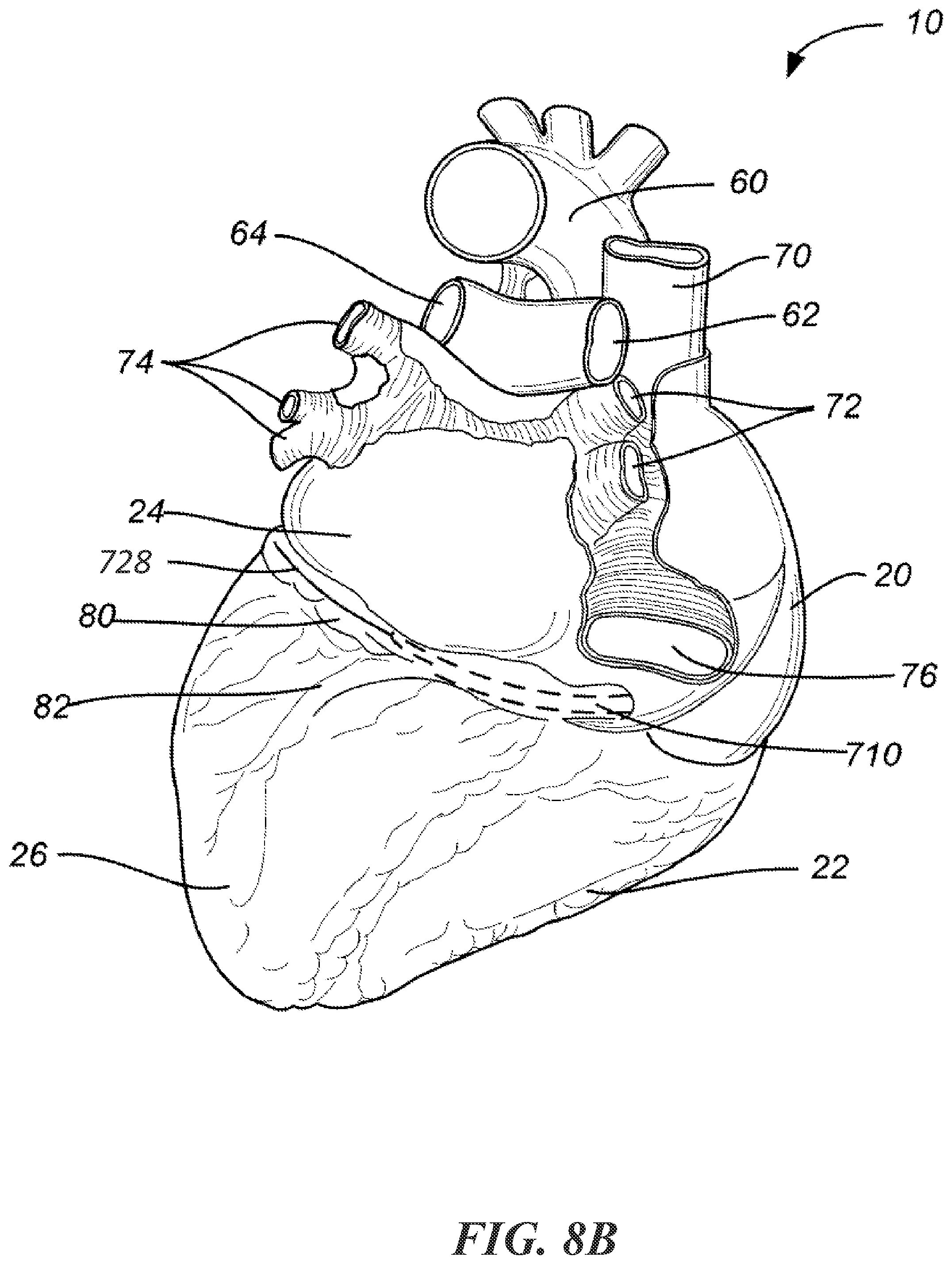 Patent US12303684 Figure 14 – Transcoronary sinus pacing of posteroseptal left ventricular base
