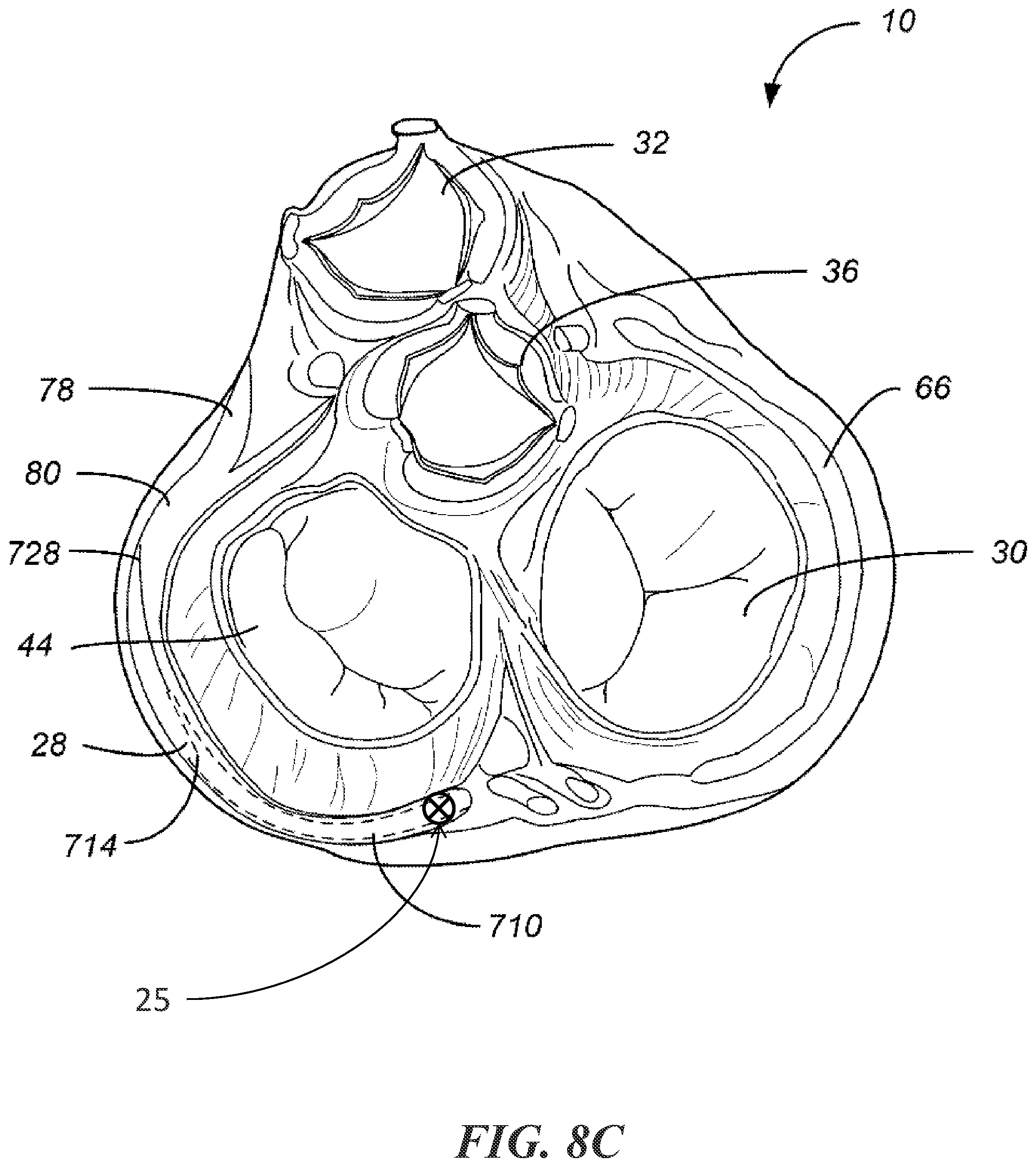 Patent US12303684 Figure 15 – Transcoronary sinus pacing of posteroseptal left ventricular base